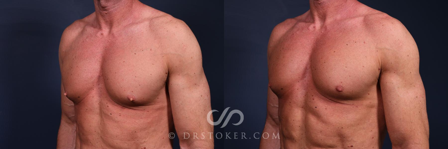 Before & After Male Nipple Reduction Case 2645 Left View in Los Angeles, CA