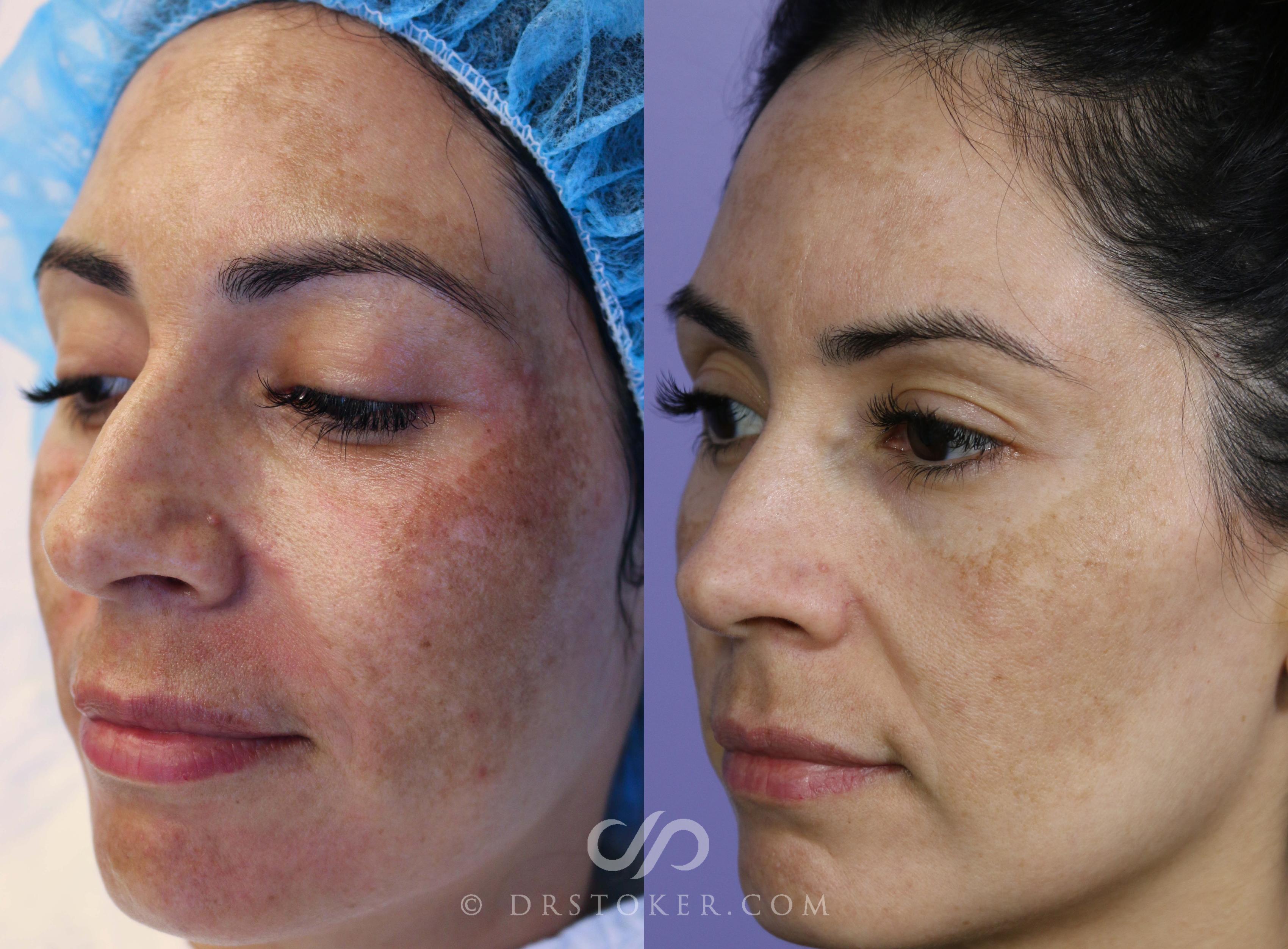 Before & After Microneedling Case 1586 View #1 View in Los Angeles, CA