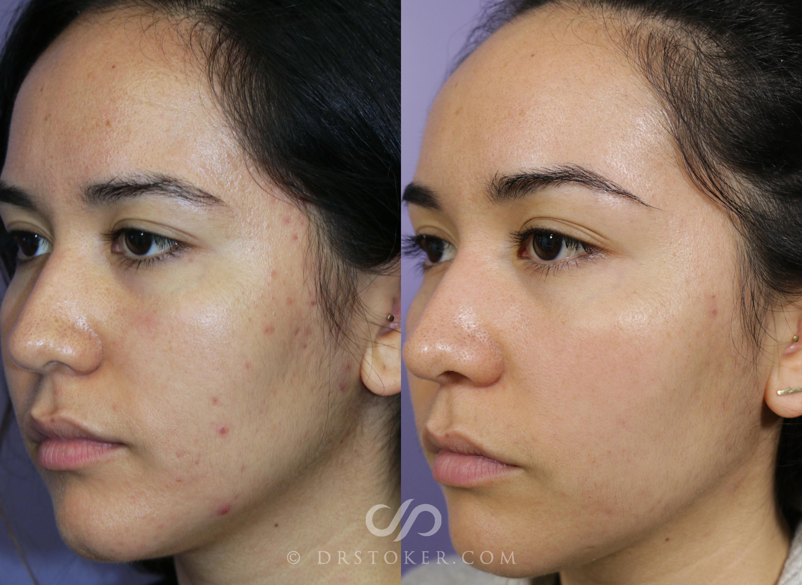 Before & After Microneedling Case 1587 View #1 View in Los Angeles, CA