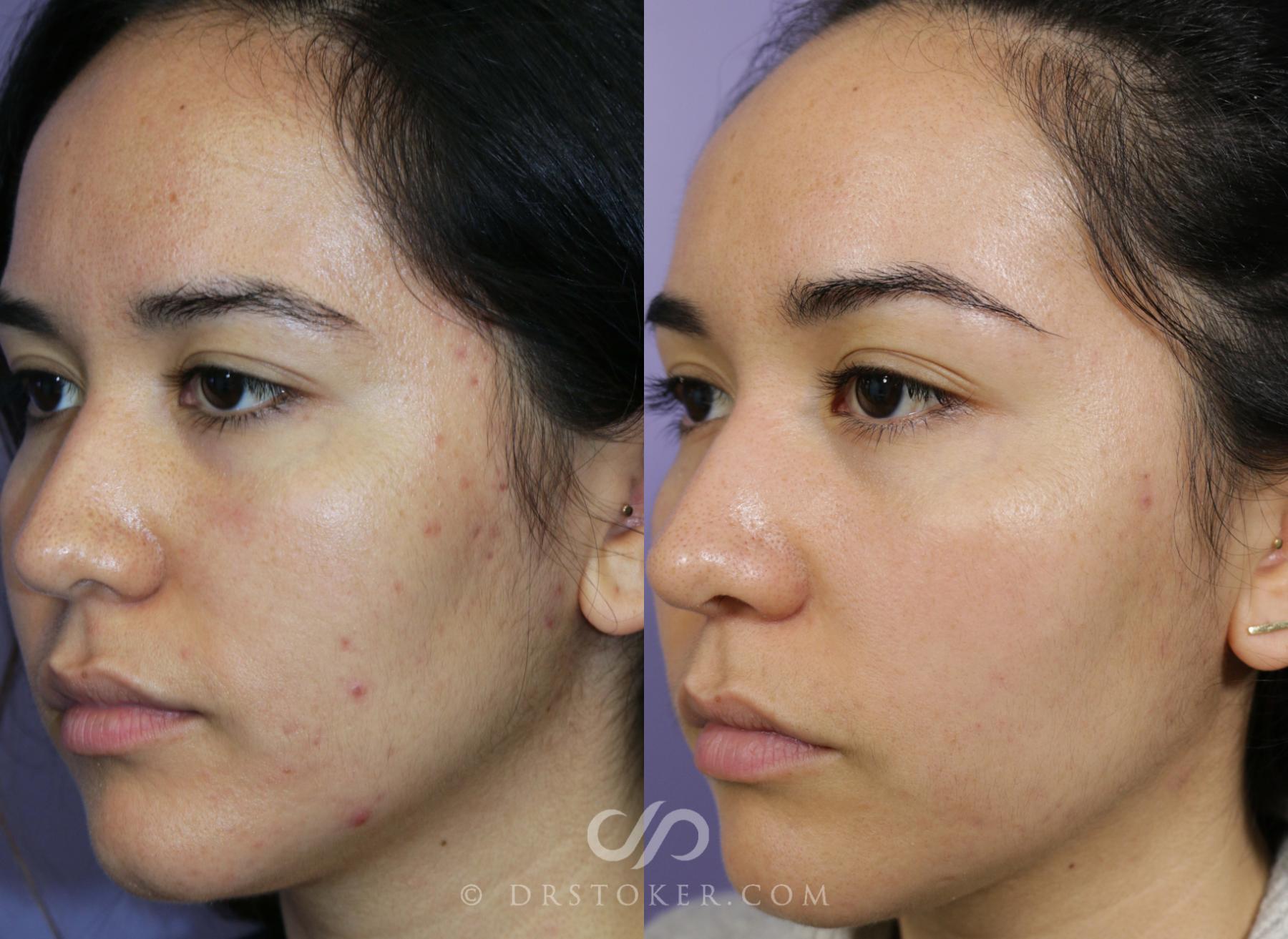 Before & After Microneedling Case 1587 View #1 View in Los Angeles, CA