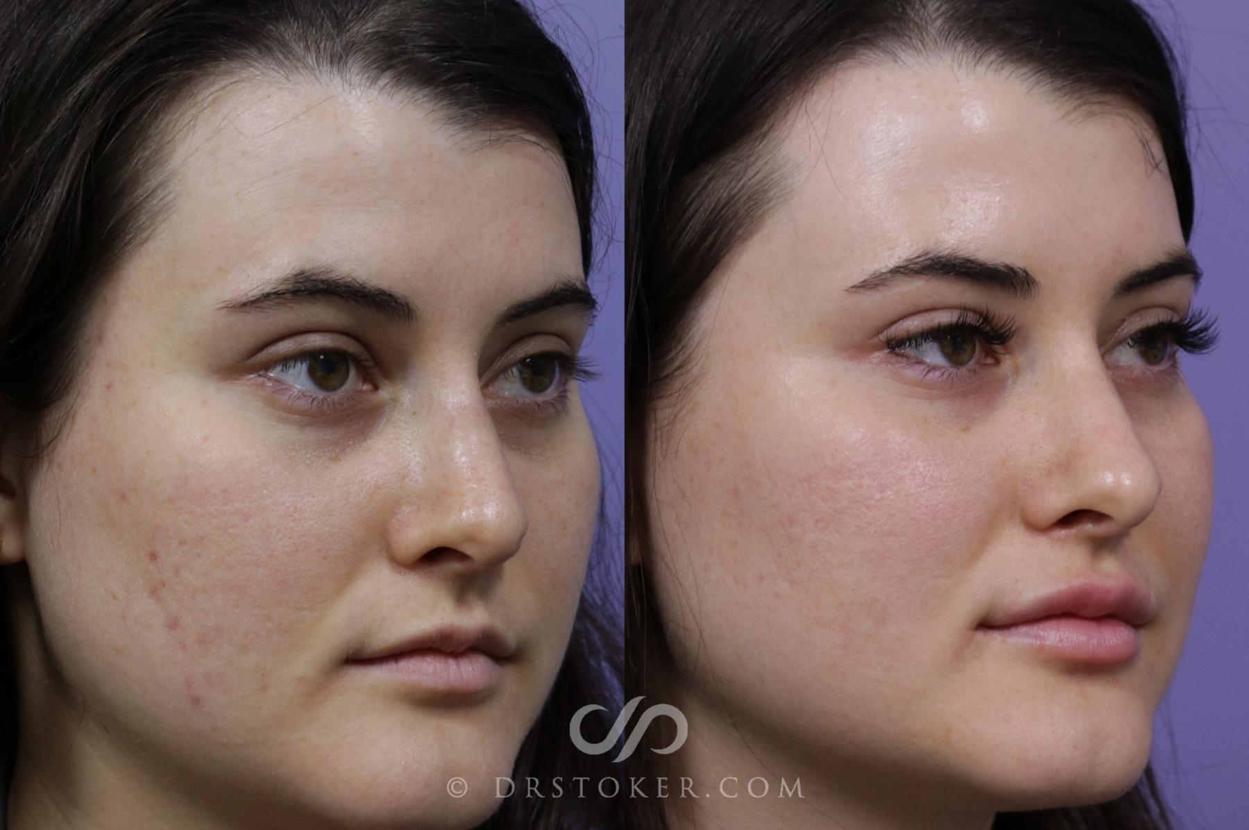 Before & After Microneedling Case 1588 View #1 View in Los Angeles, CA