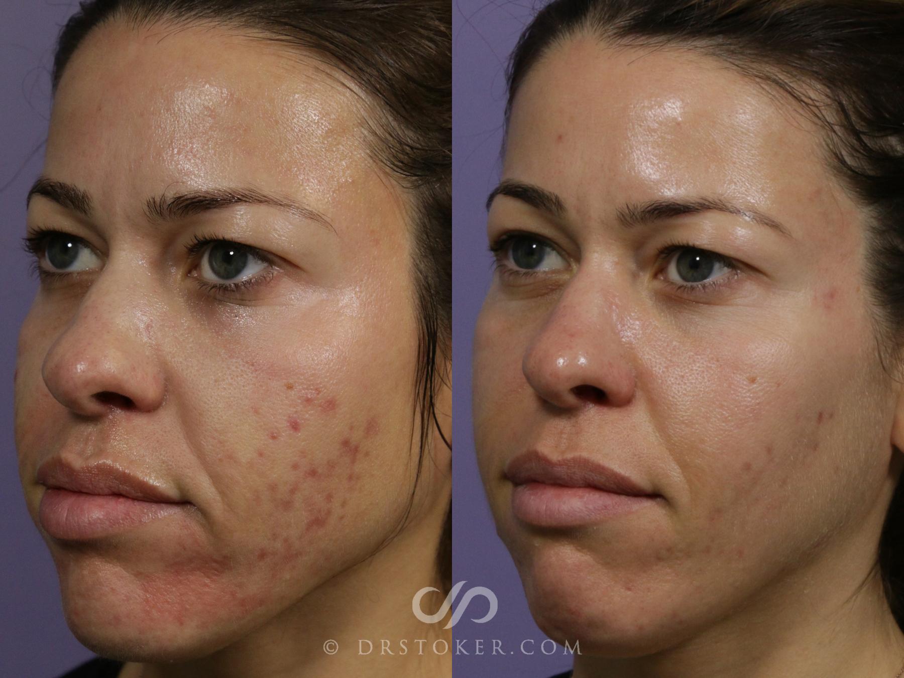 Before & After Microneedling Case 1857 Left Oblique View in Los Angeles, CA