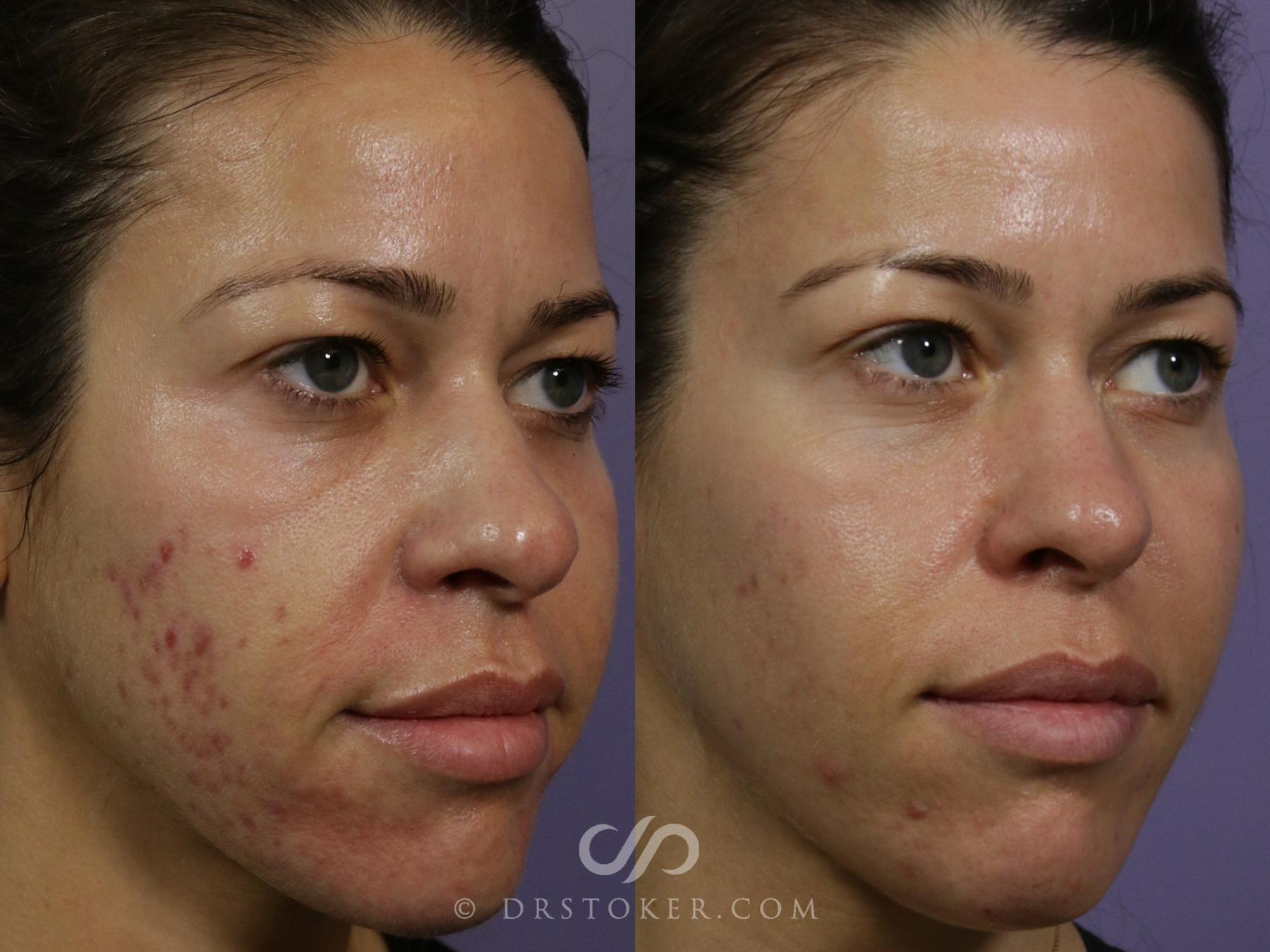 Before & After Microneedling Case 1857 Right Oblique View in Los Angeles, CA