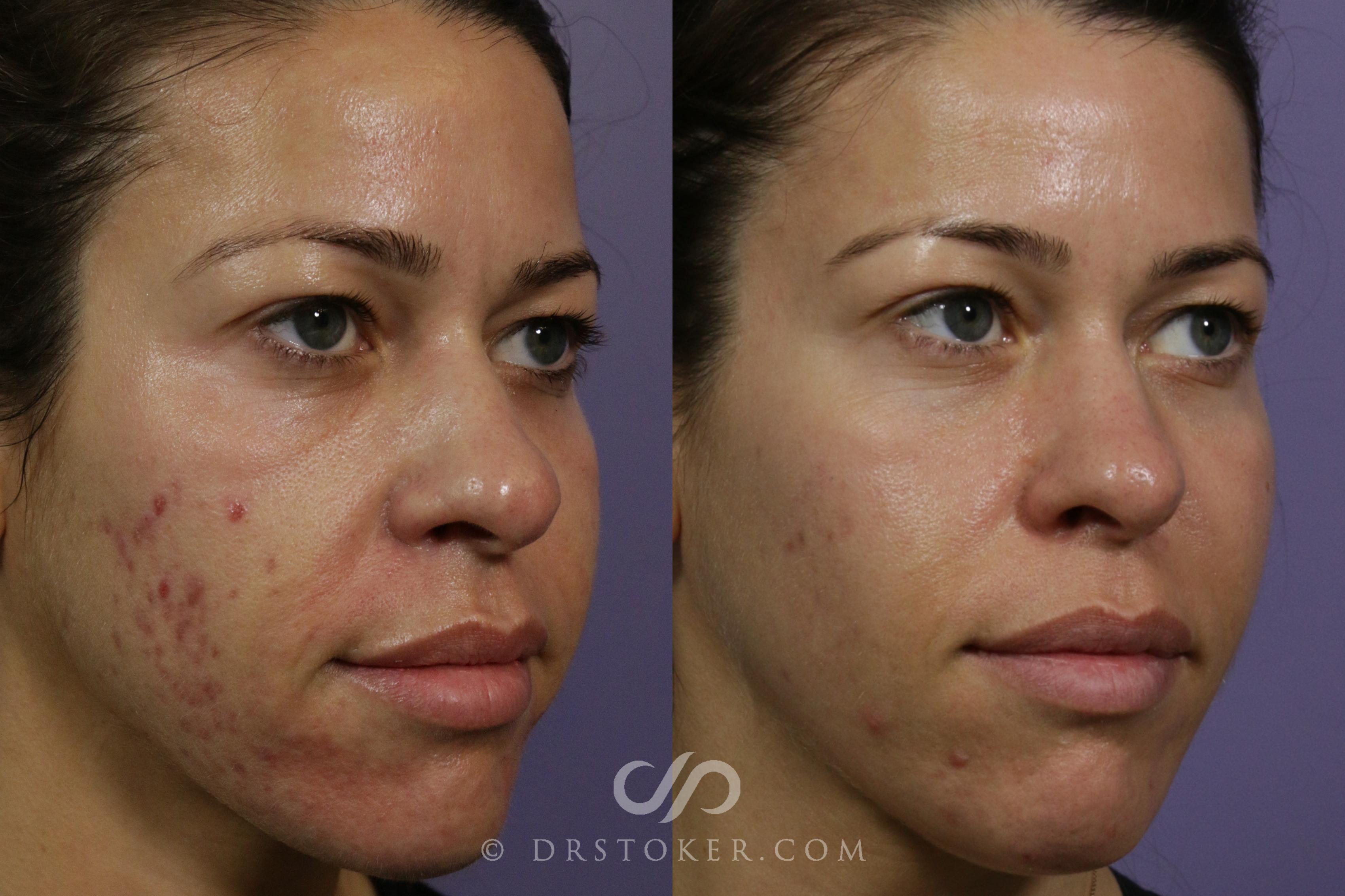 Before & After Microneedling Case 1873 Left Oblique View in Los Angeles, CA