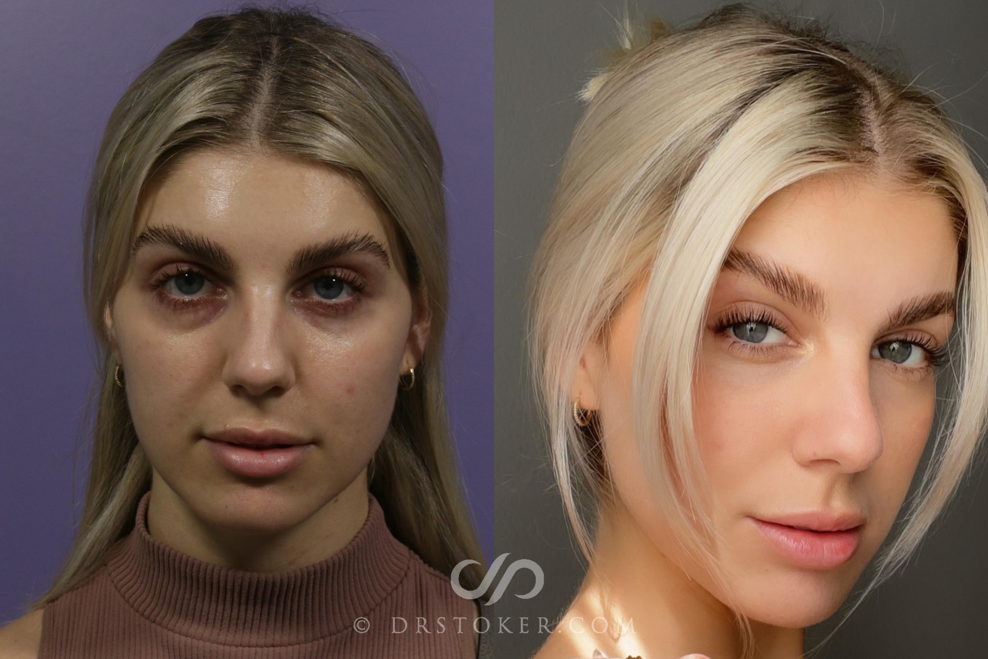 Before & After Microneedling Case 1875 Front View in Los Angeles, CA
