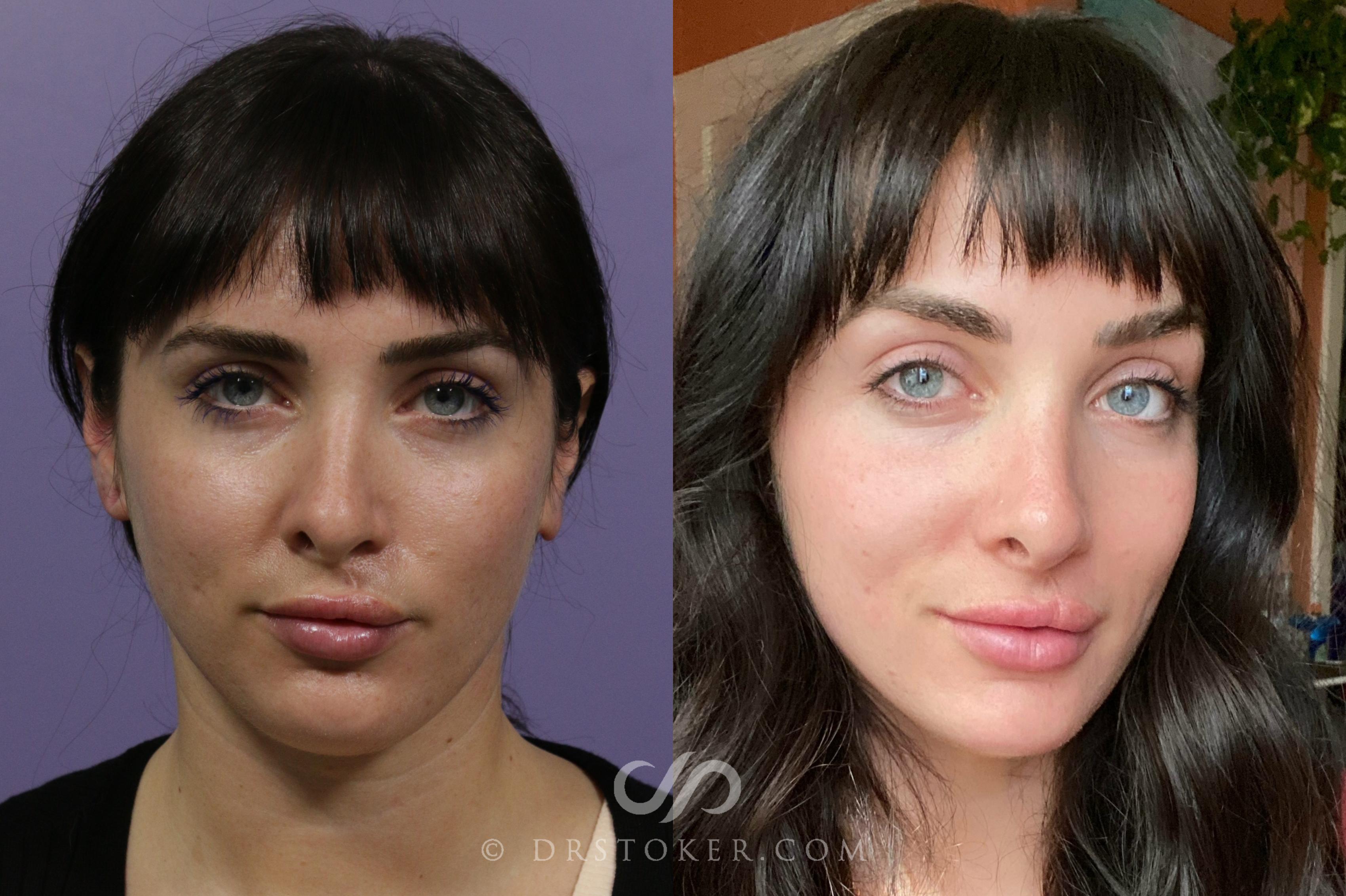 Before & After Microneedling Case 1877 Front View in Los Angeles, CA