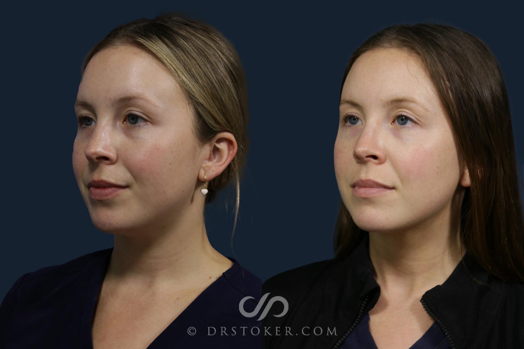 Before & After Microneedling Case 2188 Left Oblique View in Los Angeles, CA