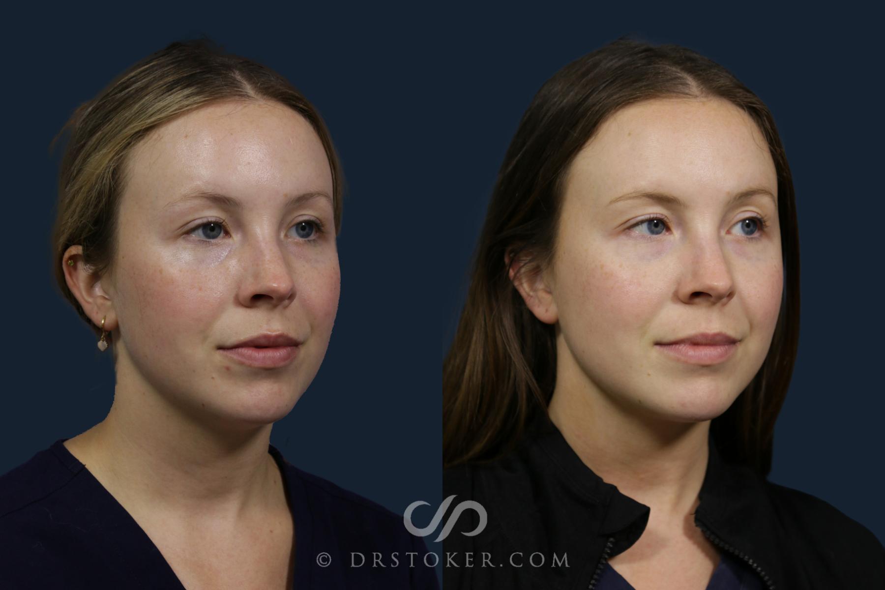 Before & After Microneedling Case 2188 Right Oblique View in Los Angeles, CA