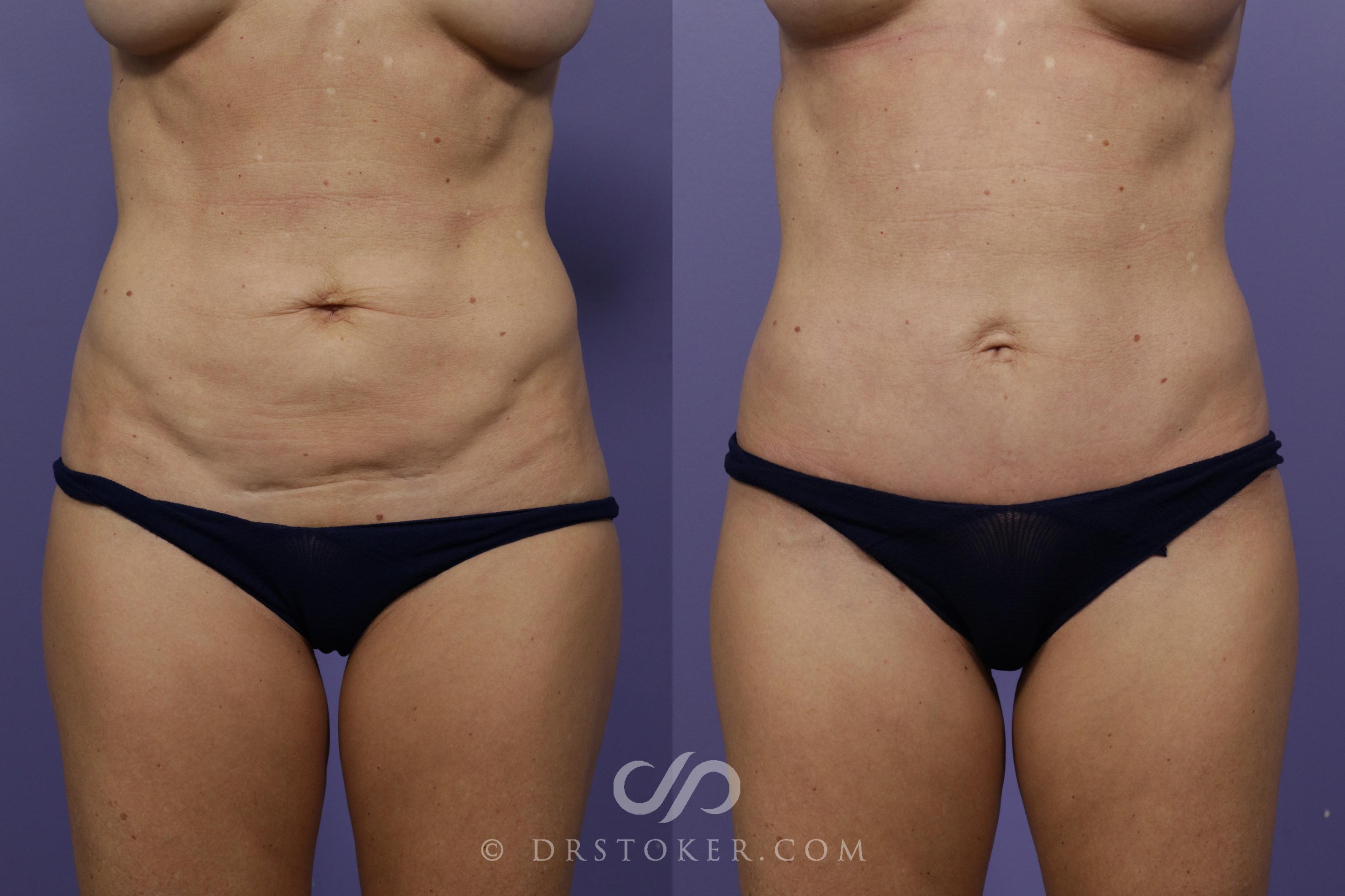 Before & After Mini Tummy Tuck Case 1565 View #1 View in Marina del Rey, CA
