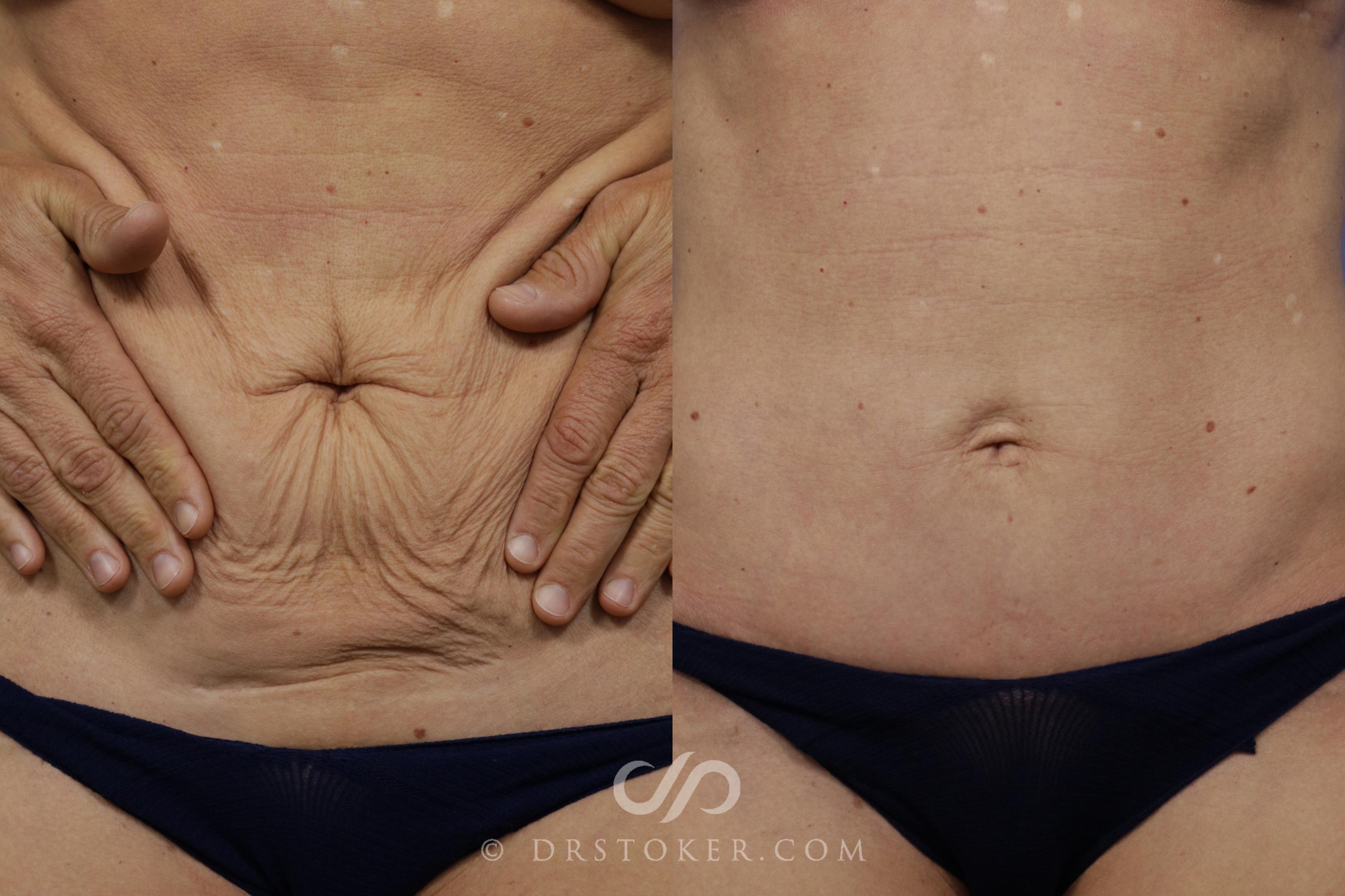 Before & After Mini Tummy Tuck Case 1566 View #1 View in Marina del Rey, CA