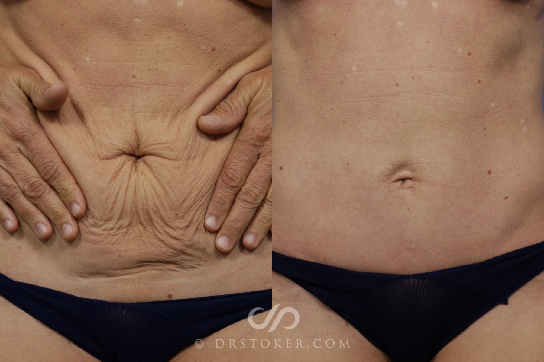 Before & After Tummy Tuck (Mini) Case 1566 View #1 View in Los Angeles, CA