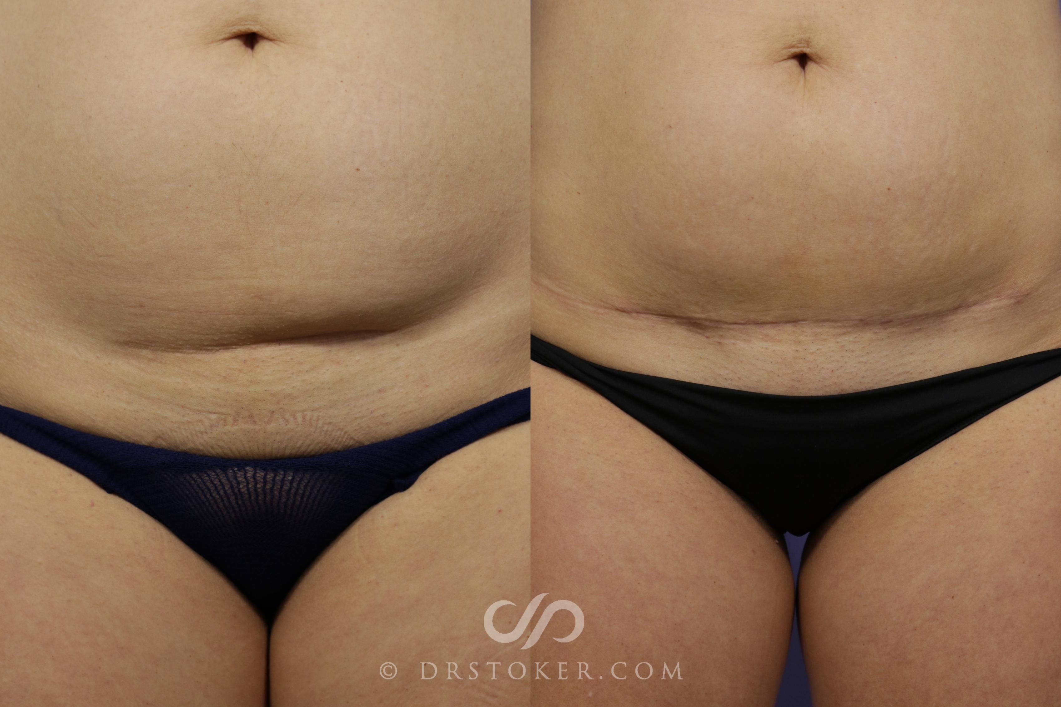Before & After Mini Tummy Tuck Case 1570 View #1 View in Los Angeles, CA