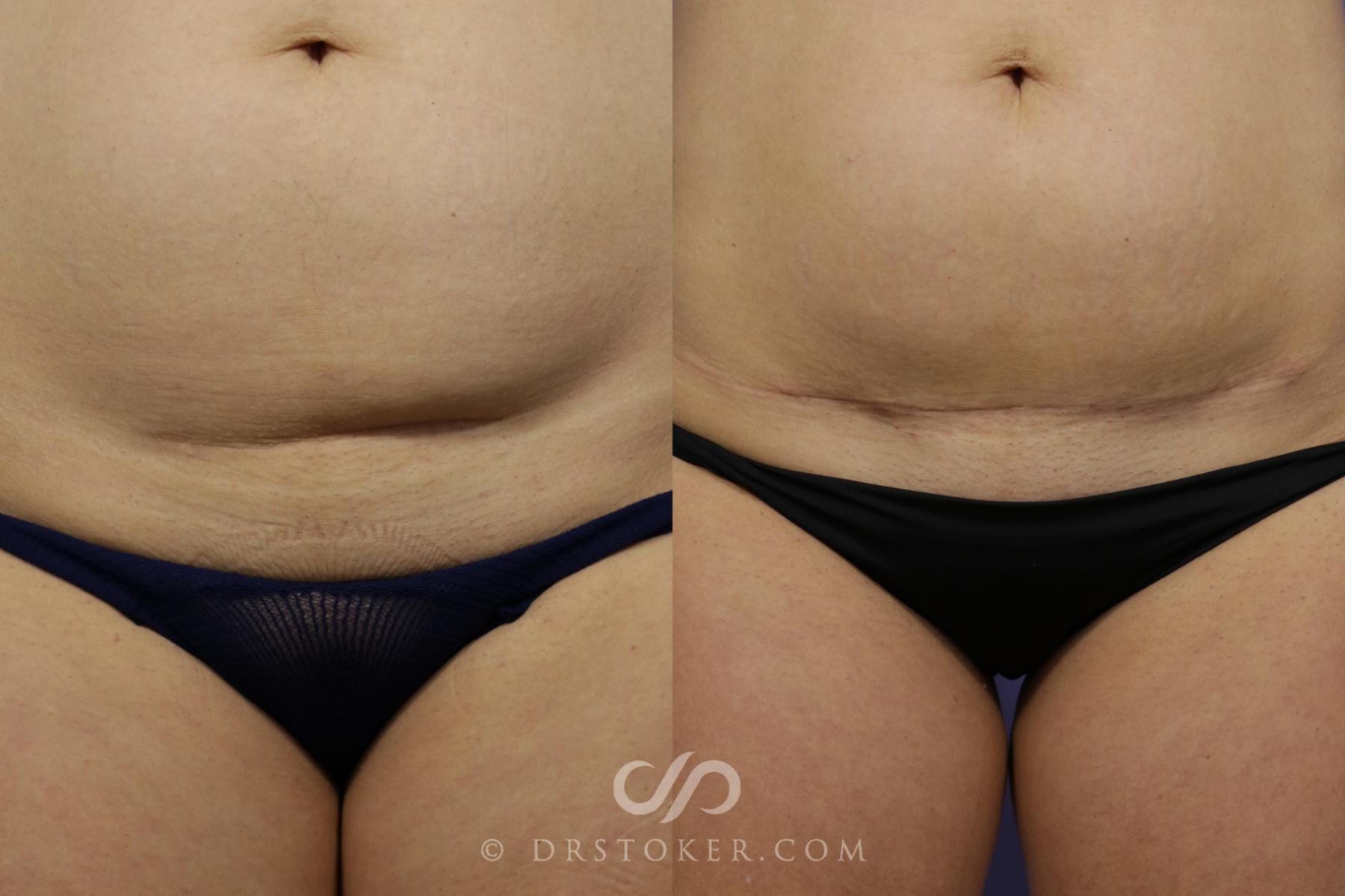 Before & After Tummy Tuck (Mini) Case 1570 View #1 View in Los Angeles, CA