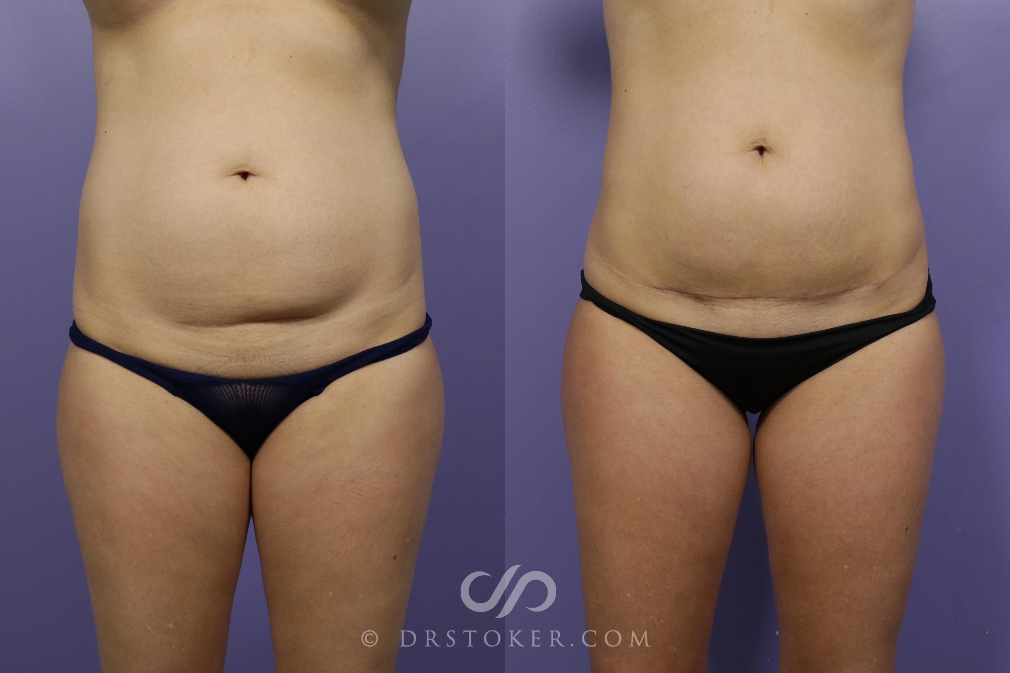 Before & After Tummy Tuck (Mini) Case 1570 View #2 View in Los Angeles, CA