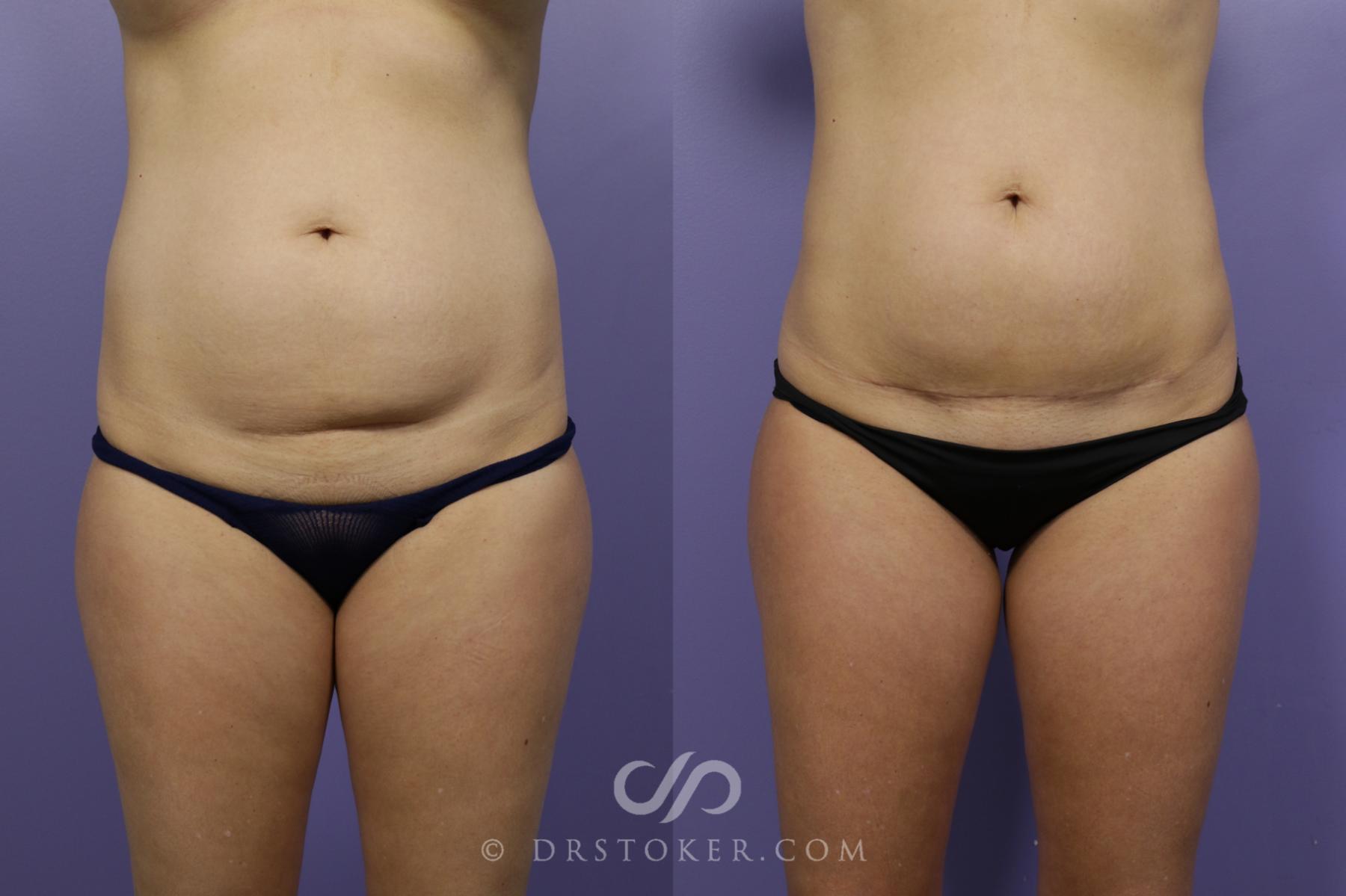Before & After Tummy Tuck (Mini) Case 1570 View #2 View in Los Angeles, CA