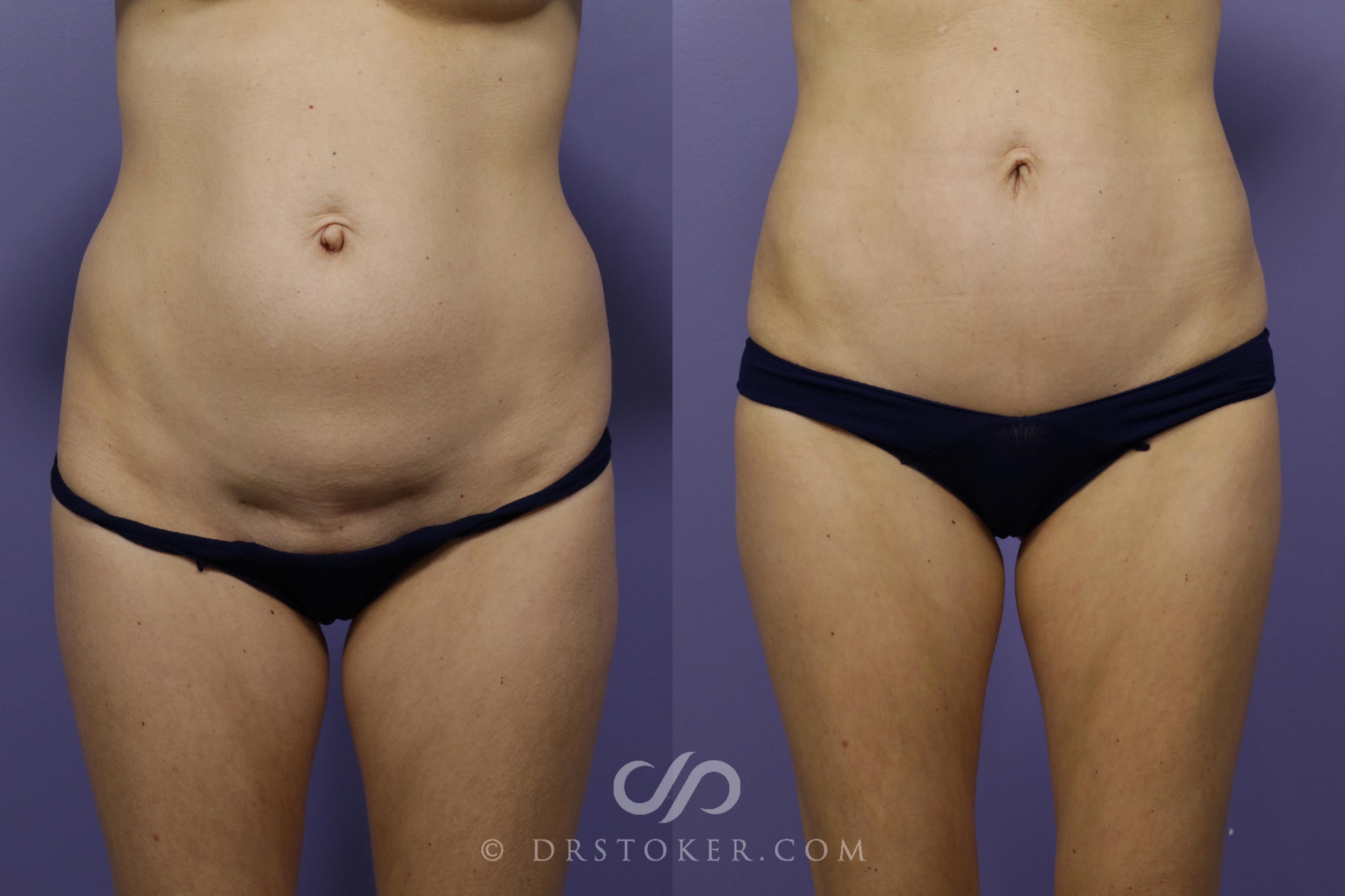 Before & After Mini Tummy Tuck Case 1573 View #1 View in Marina del Rey, CA
