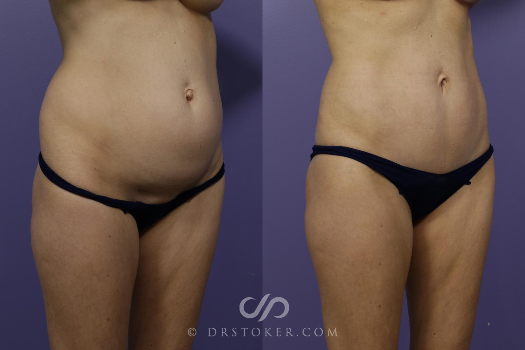 Before & After Tummy Tuck (Mini) Case 1573 View #2 View in Los Angeles, CA