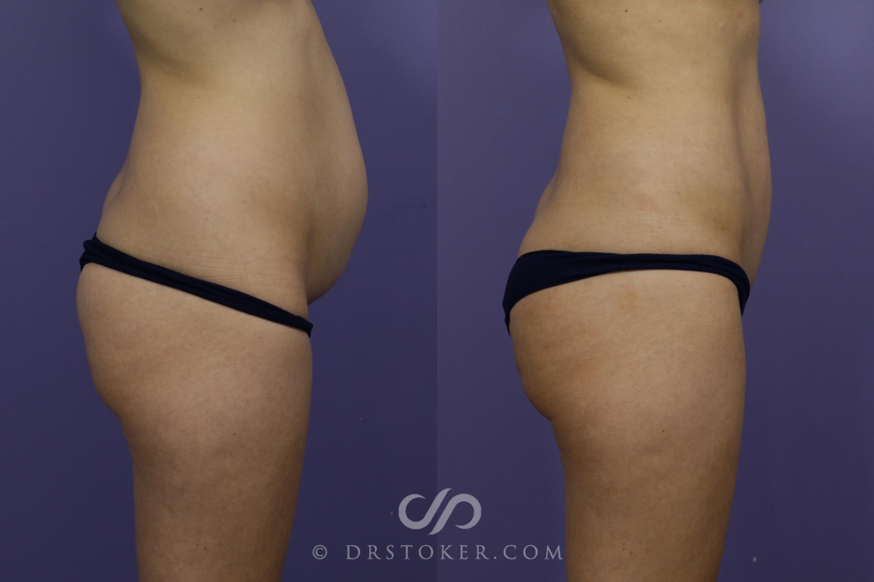 Before & After Tummy Tuck (Mini) Case 1573 View #3 View in Los Angeles, CA