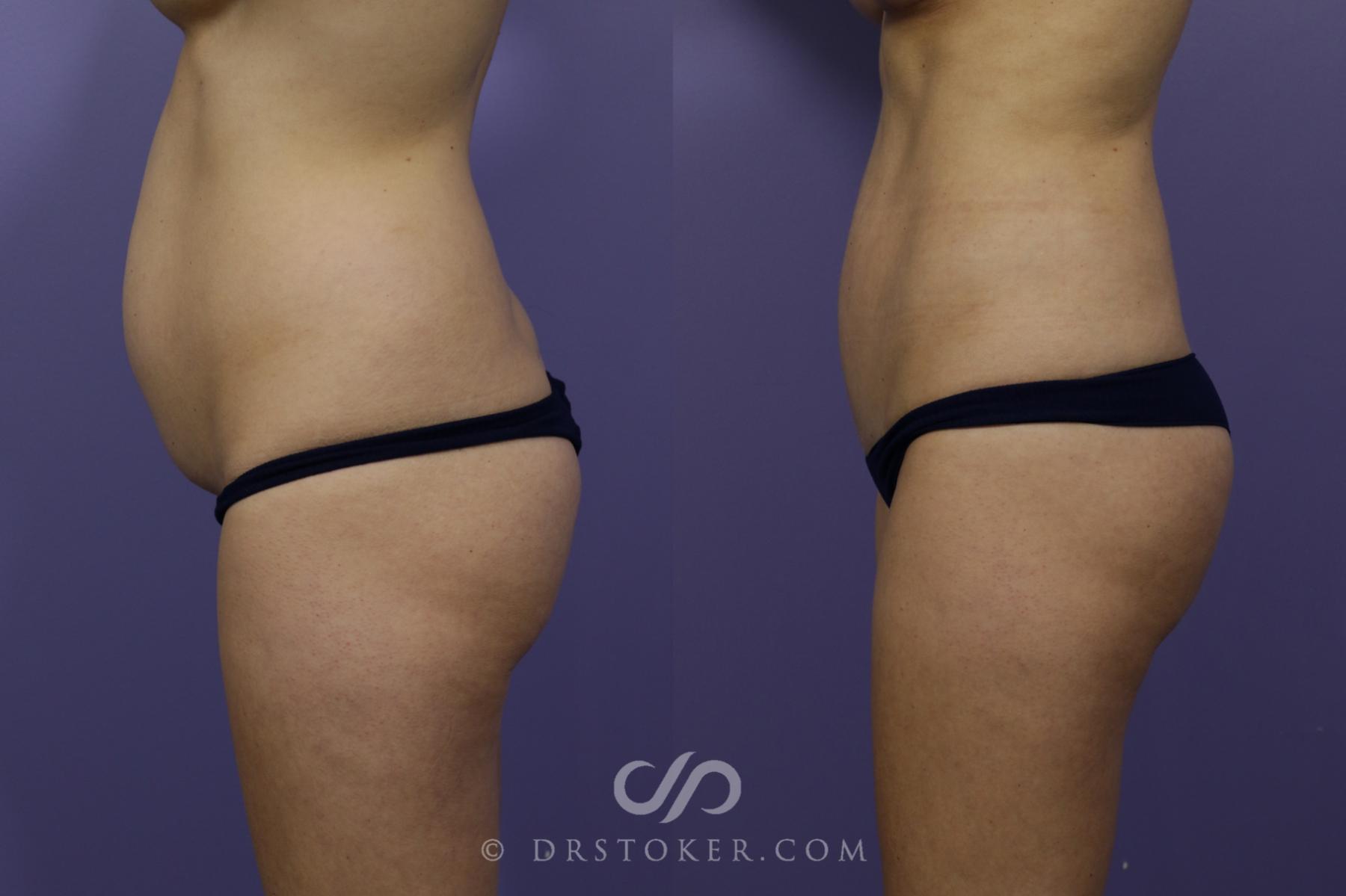 Before & After Tummy Tuck (Mini) Case 1573 View #4 View in Los Angeles, CA