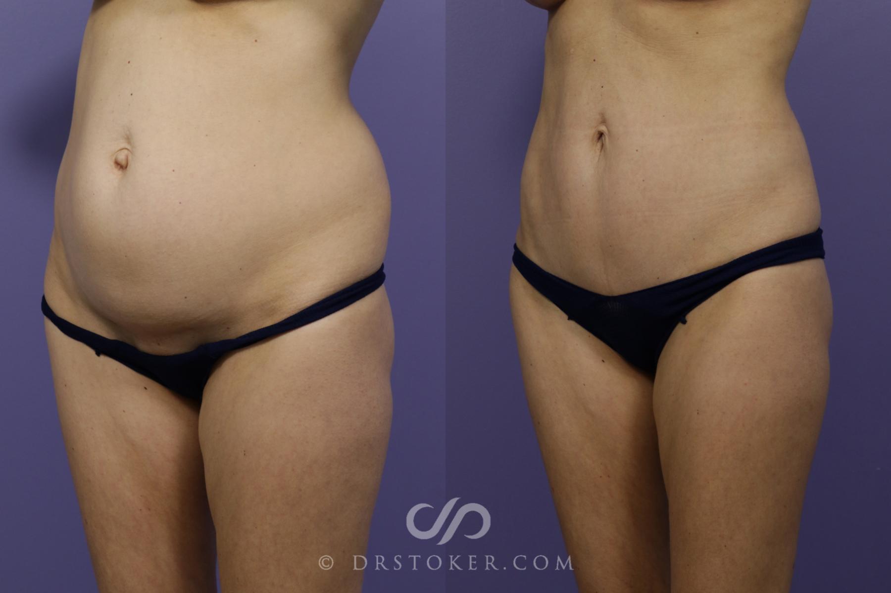 Before & After Tummy Tuck (Mini) Case 1573 View #5 View in Los Angeles, CA