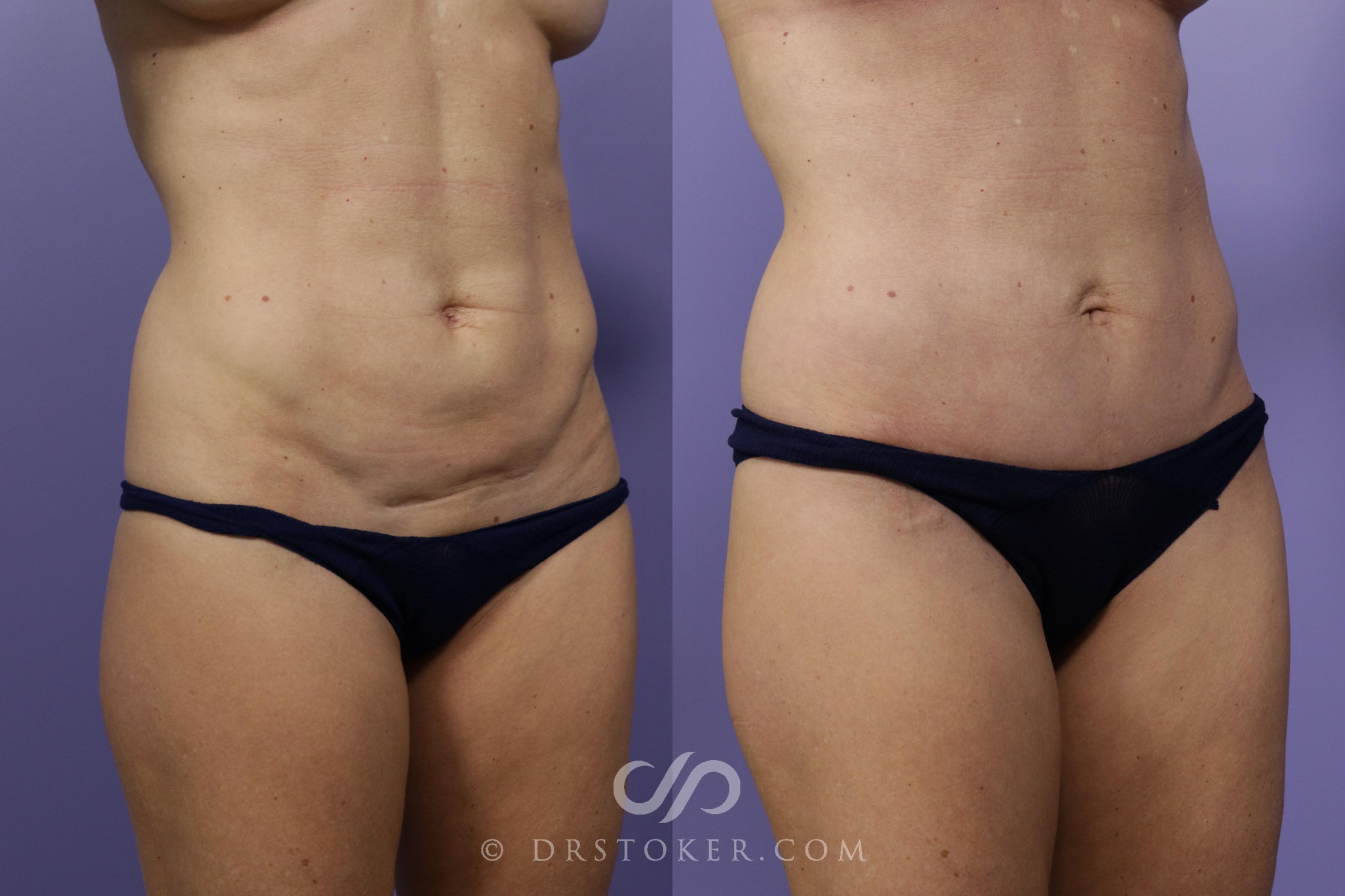 Before & After Mini Tummy Tuck Case 1784 View #1 View in Marina del Rey, CA