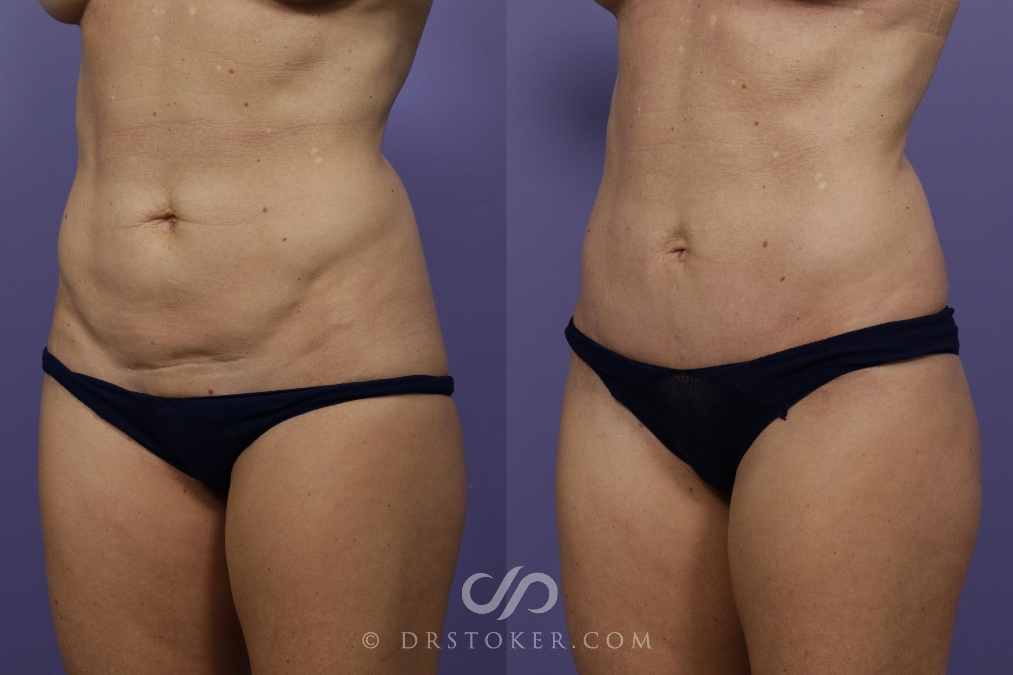 Before & After Mini Tummy Tuck Case 1785 View #1 View in Marina del Rey, CA