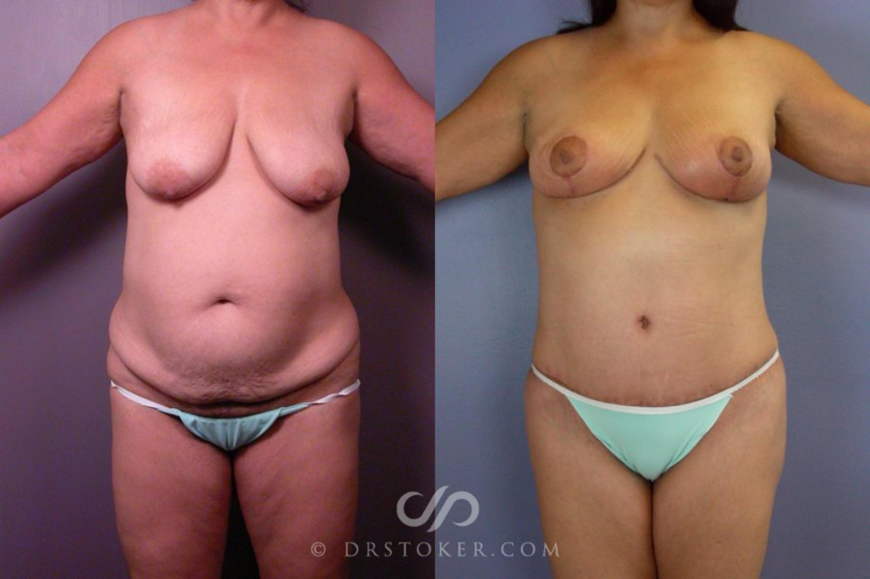 Before & After Tummy Tuck Case 112 View #1 View in Los Angeles, CA
