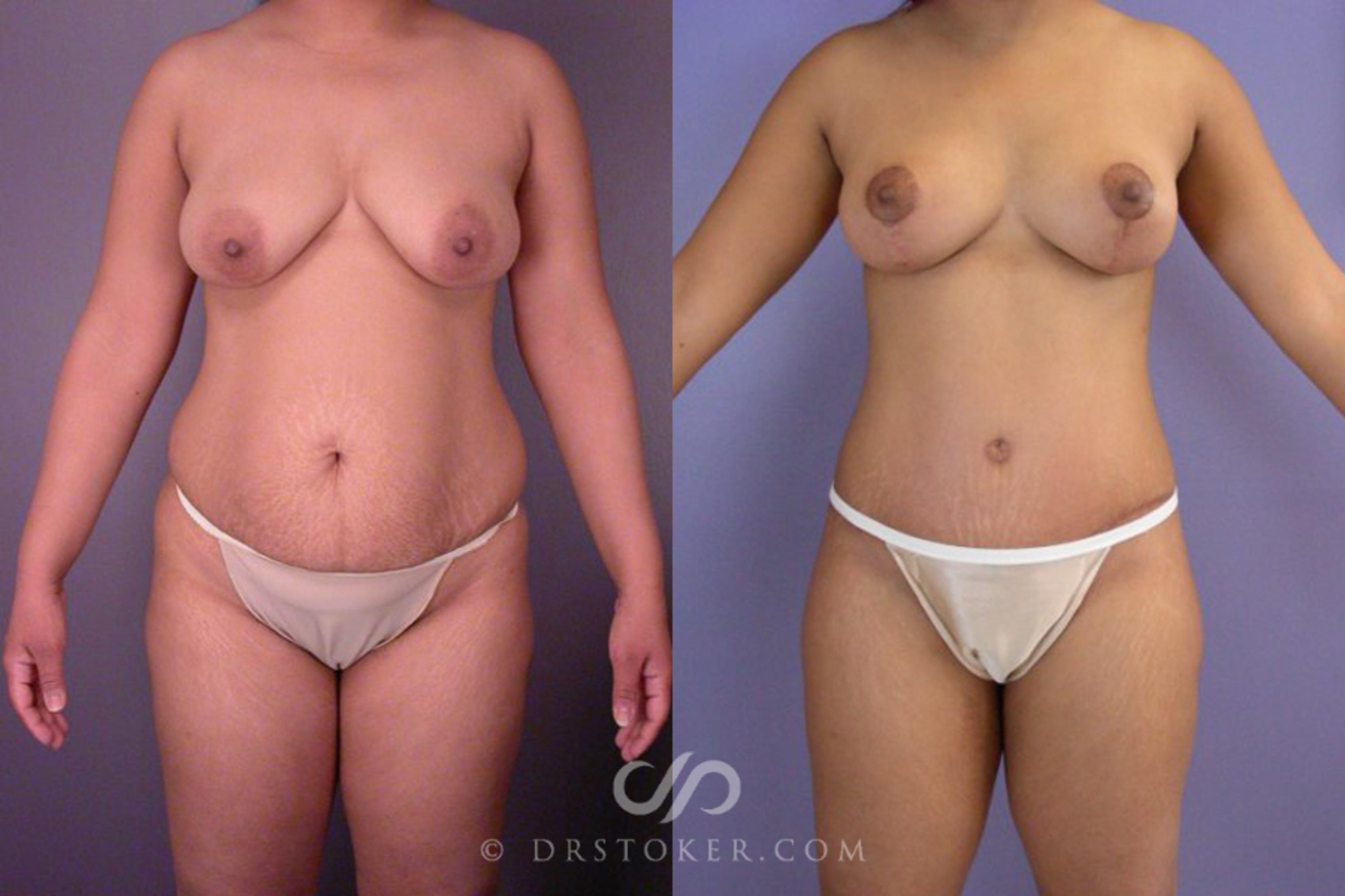 Before & After Tummy Tuck Case 114 View #1 View in Los Angeles, CA