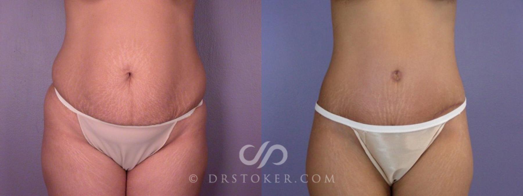 Before & After Tummy Tuck Case 114 View #11 View in Los Angeles, CA
