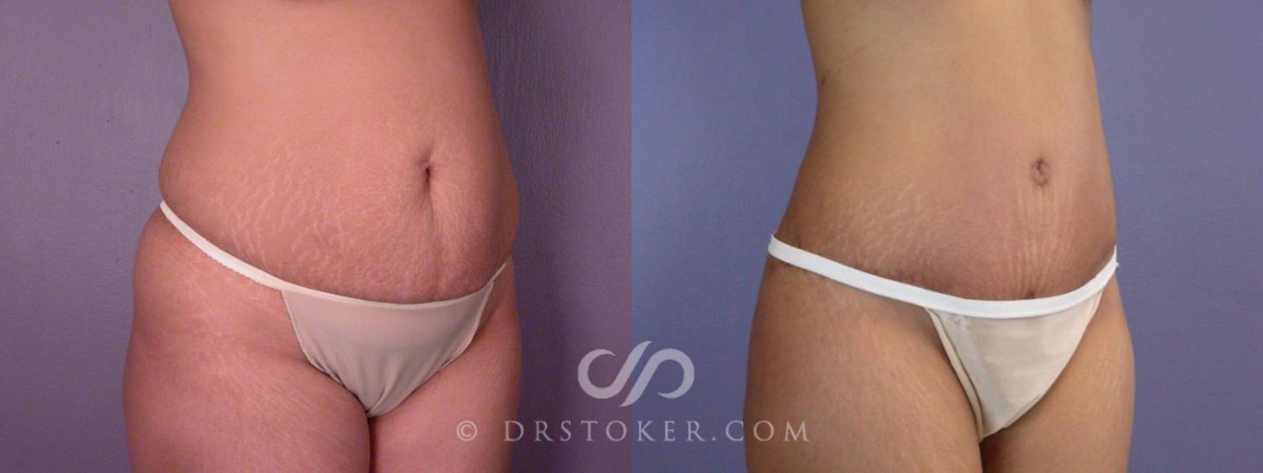 Before & After Tummy Tuck Case 114 View #12 View in Los Angeles, CA