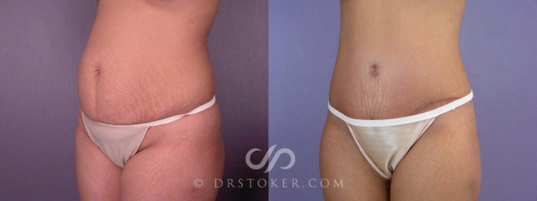 Before & After Tummy Tuck Case 114 View #13 View in Los Angeles, CA