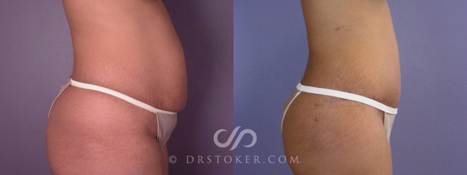 Before & After Tummy Tuck Case 114 View #14 View in Los Angeles, CA