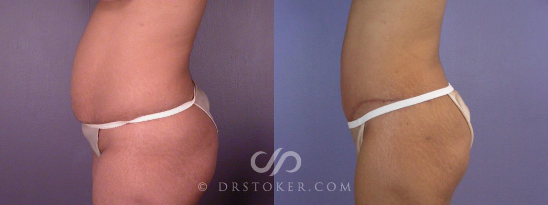Before & After Tummy Tuck Case 114 View #15 View in Los Angeles, CA