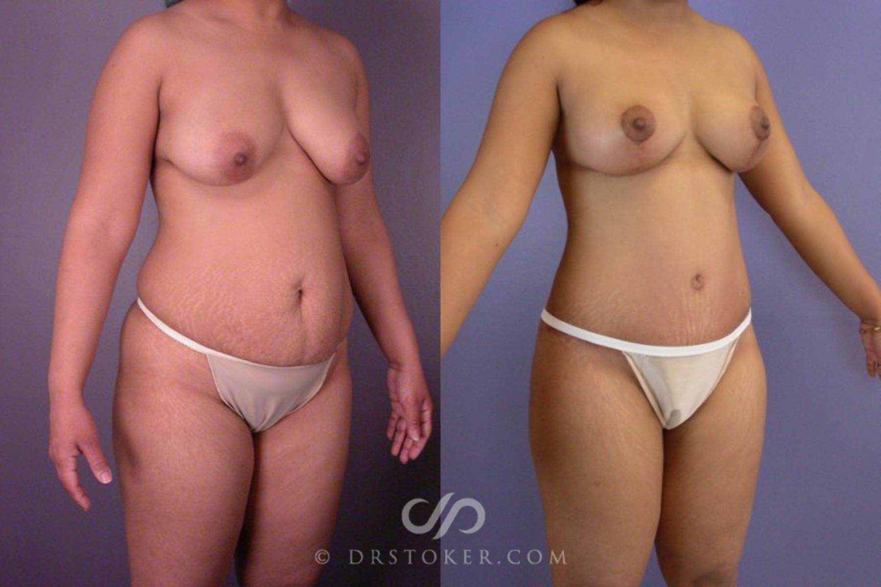 Before & After Tummy Tuck Case 114 View #2 View in Los Angeles, CA