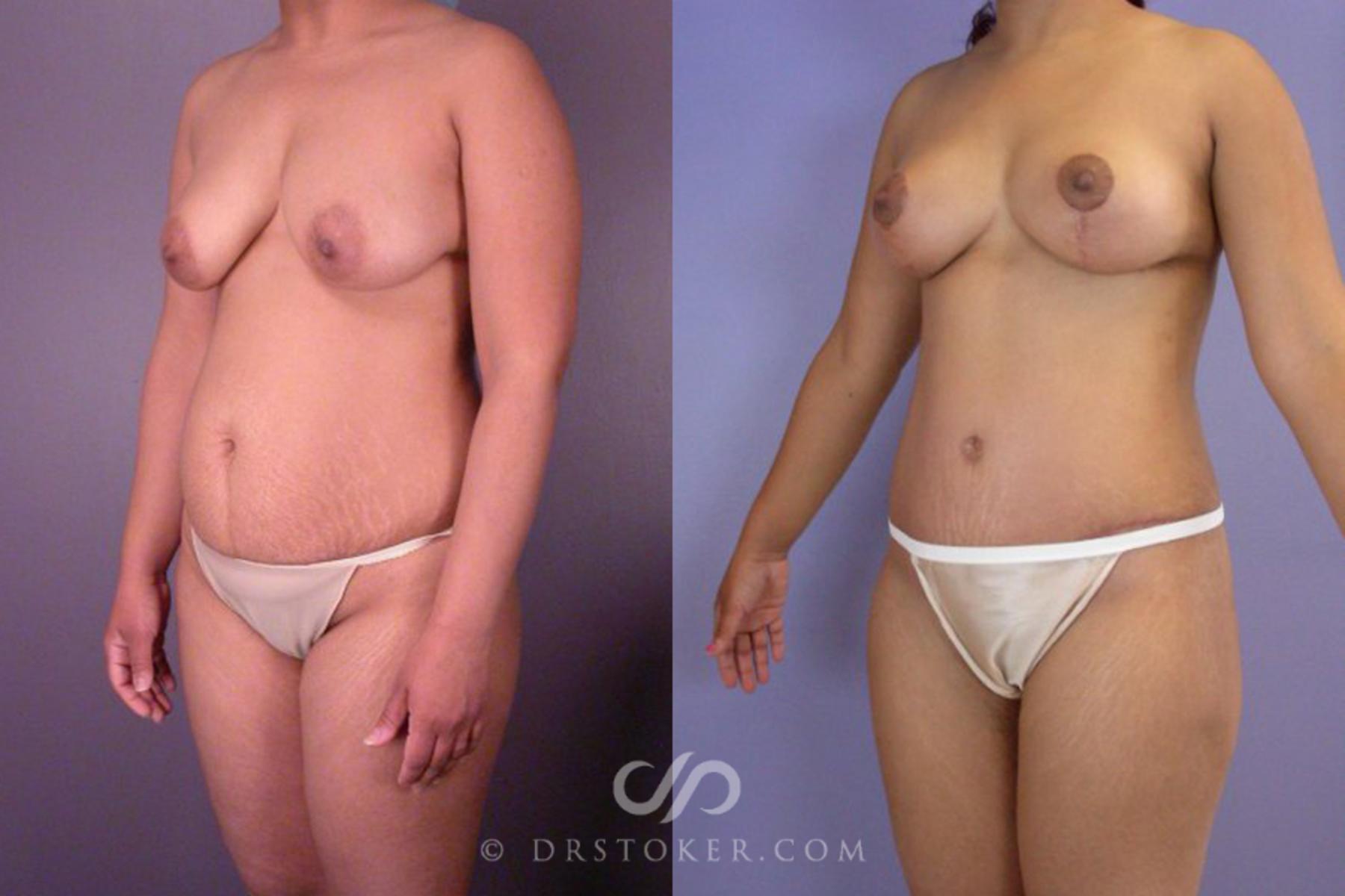 Before & After Tummy Tuck Case 114 View #3 View in Los Angeles, CA