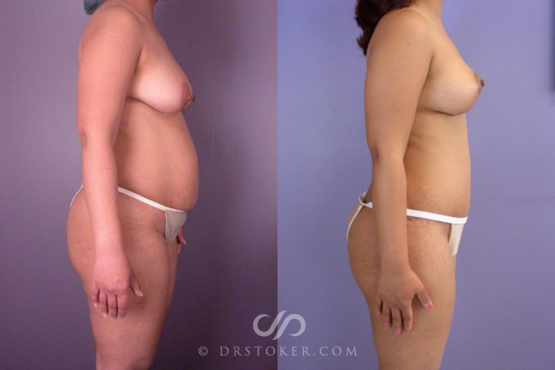 Before & After Tummy Tuck Case 114 View #4 View in Los Angeles, CA