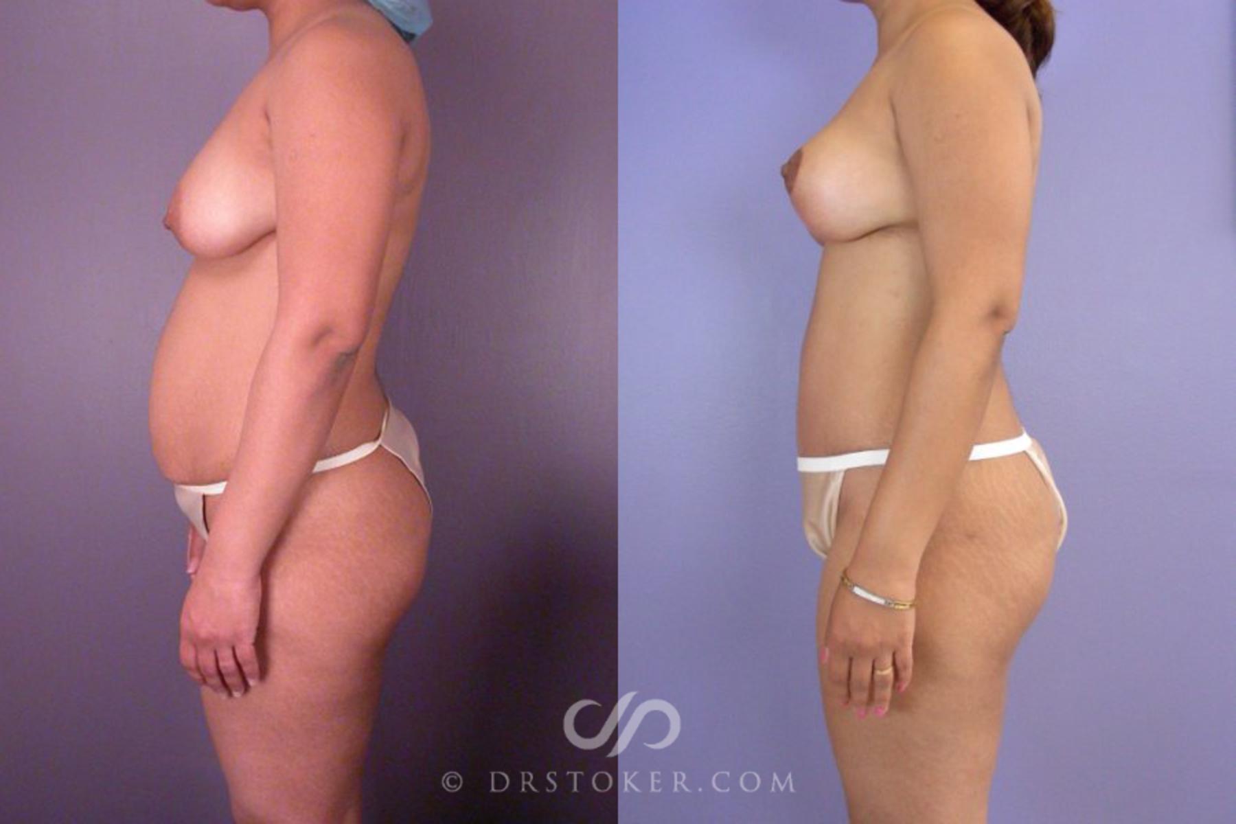 Before & After Tummy Tuck Case 114 View #5 View in Los Angeles, CA
