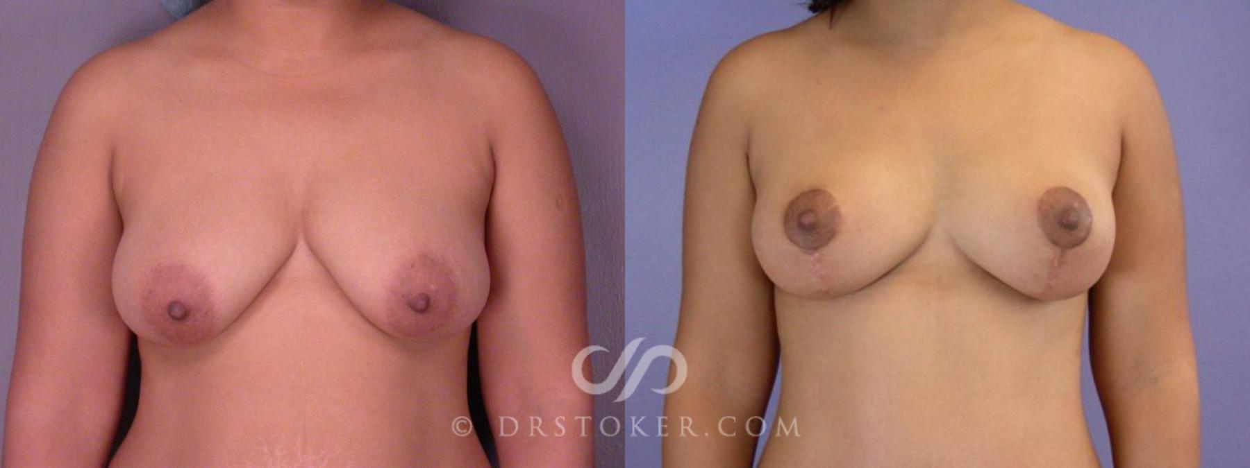 Before & After Tummy Tuck Case 114 View #6 View in Los Angeles, CA