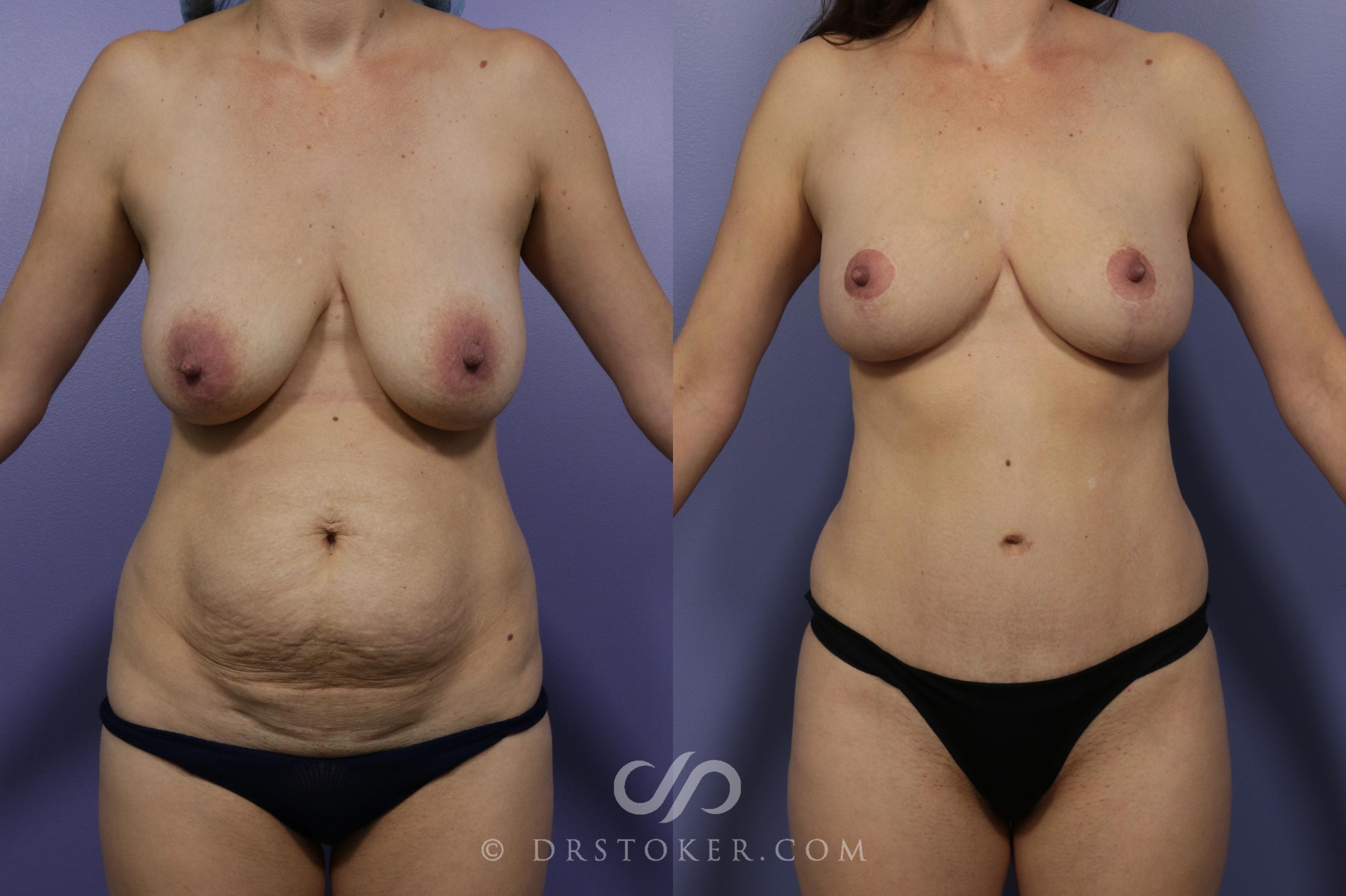 Before & After Breast Lift Case 1168 View #1 View in Los Angeles, CA