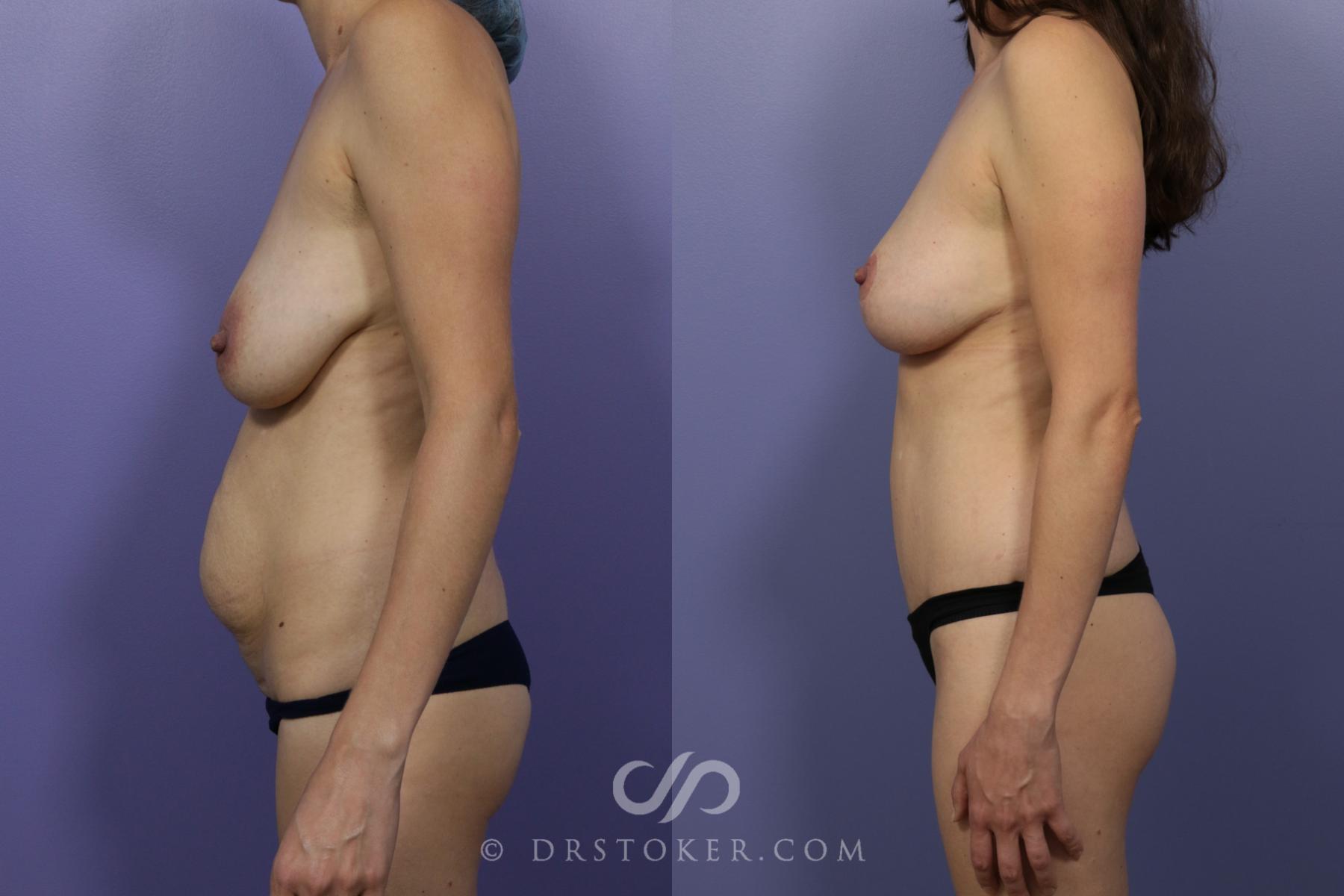 Before & After Breast Lift Case 1168 View #2 View in Los Angeles, CA
