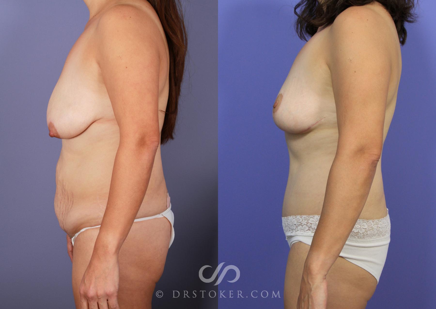 Before & After Mommy Makeover Case 1171 View #3 View in Los Angeles, CA