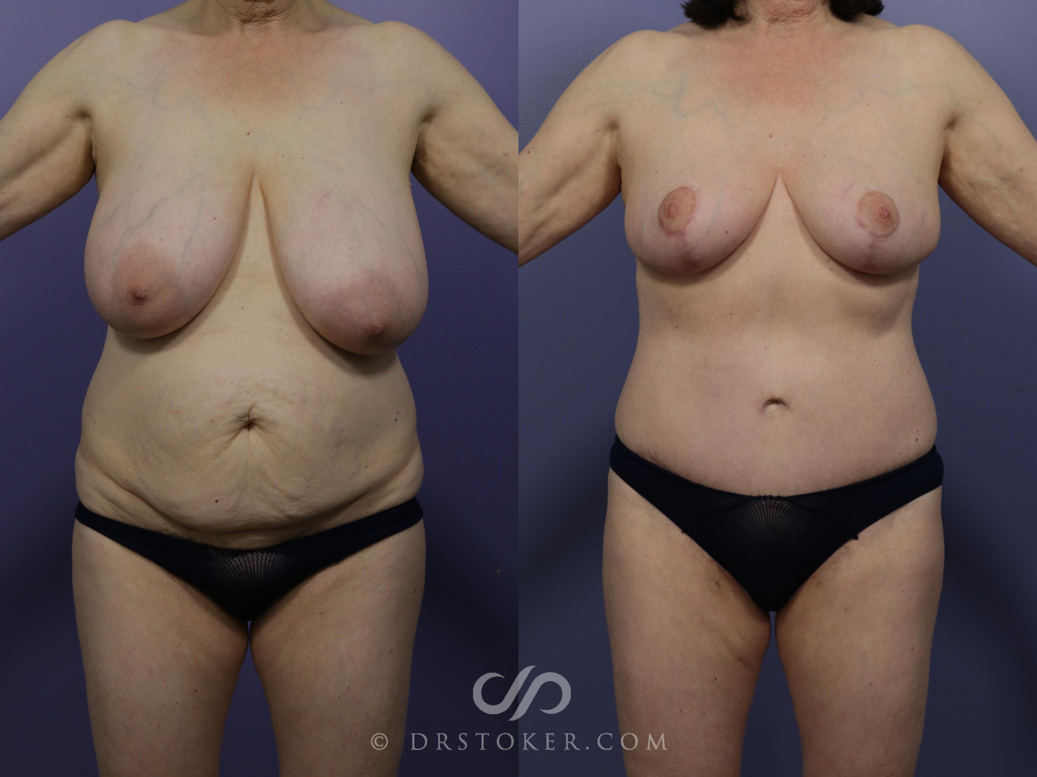 Before & After Mommy Makeover Case 1173 View #1 View in Marina del Rey, CA