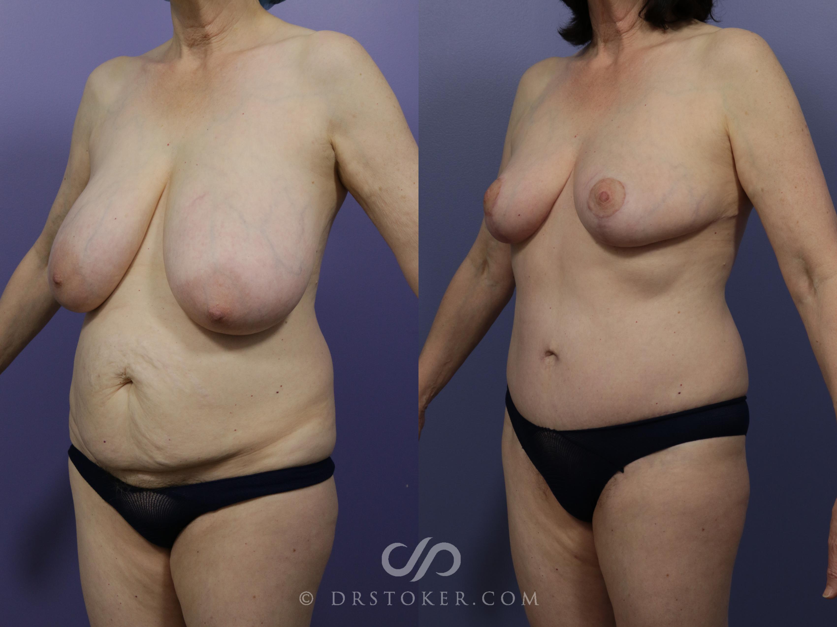 Before & After Mommy Makeover Case 1173 View #2 View in Los Angeles, CA