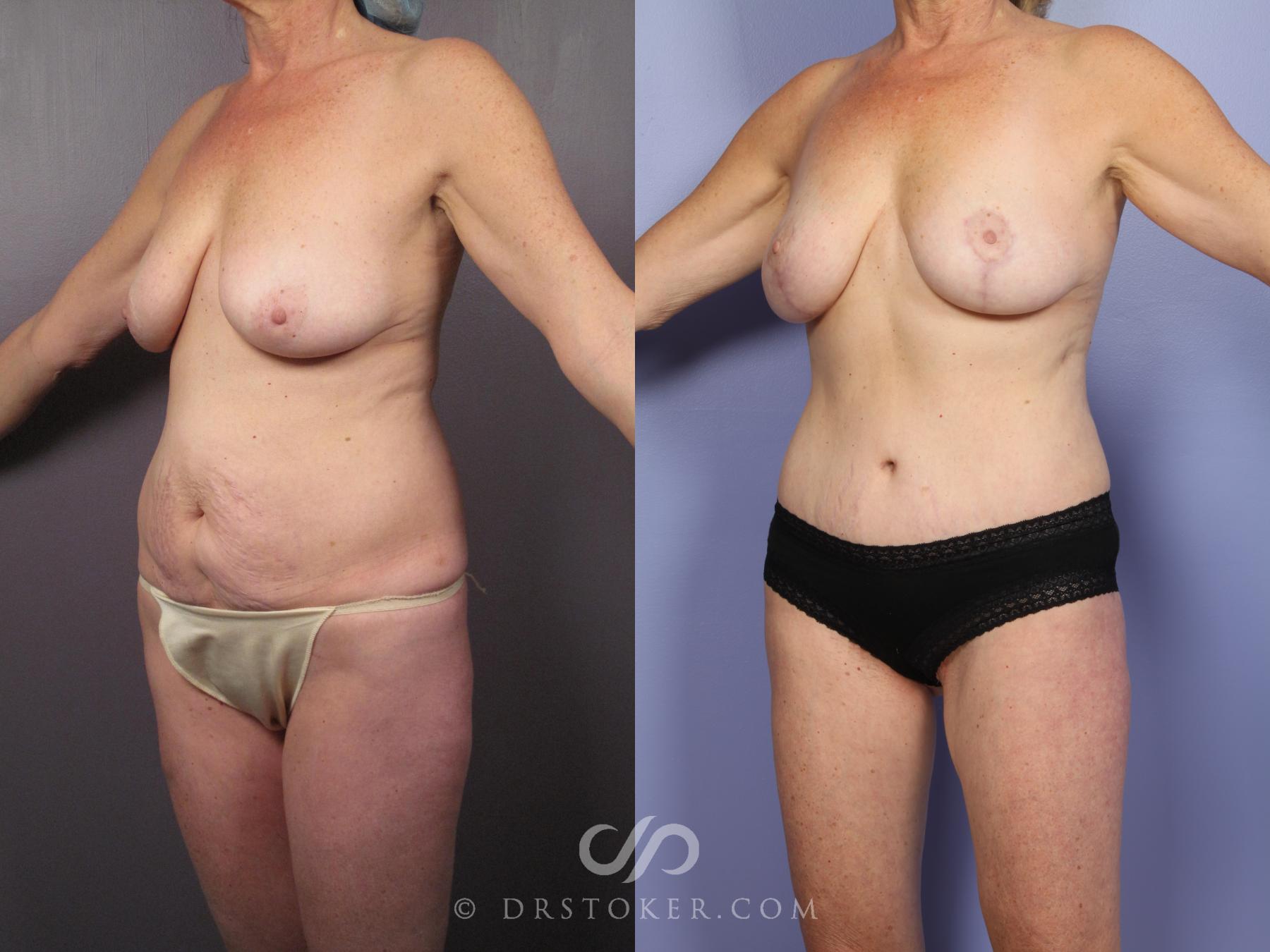 Before & After Mommy Makeover Case 1462 View #3 View in Los Angeles, CA
