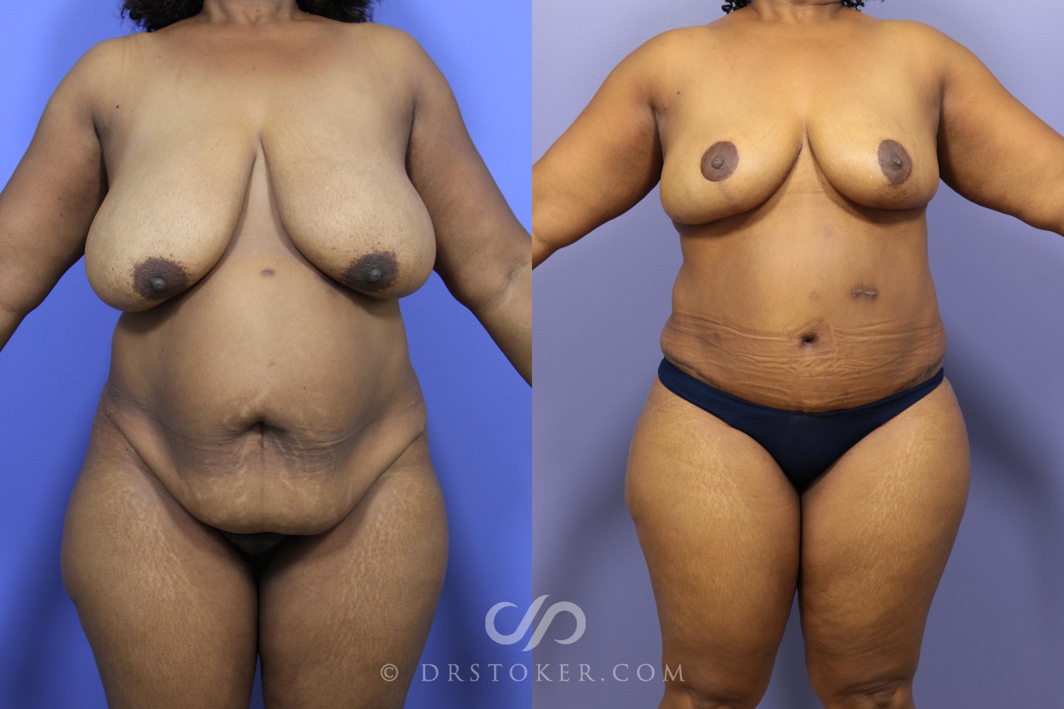 Before & After After Weight Loss Case 1463 View #1 View in Los Angeles, CA