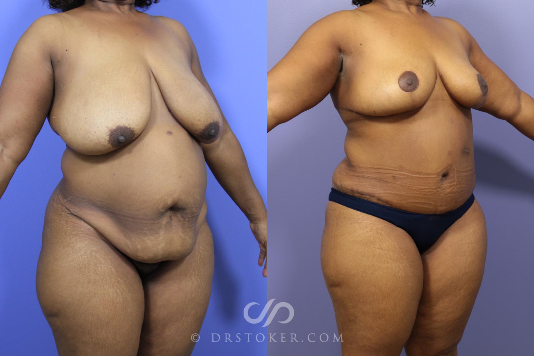 Before & After After Weight Loss Case 1463 View #2 View in Los Angeles, CA