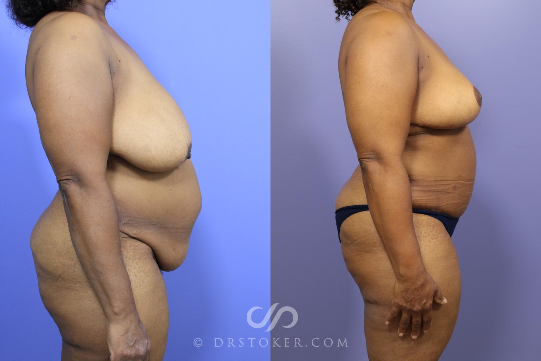 Before & After After Weight Loss Case 1463 View #3 View in Los Angeles, CA