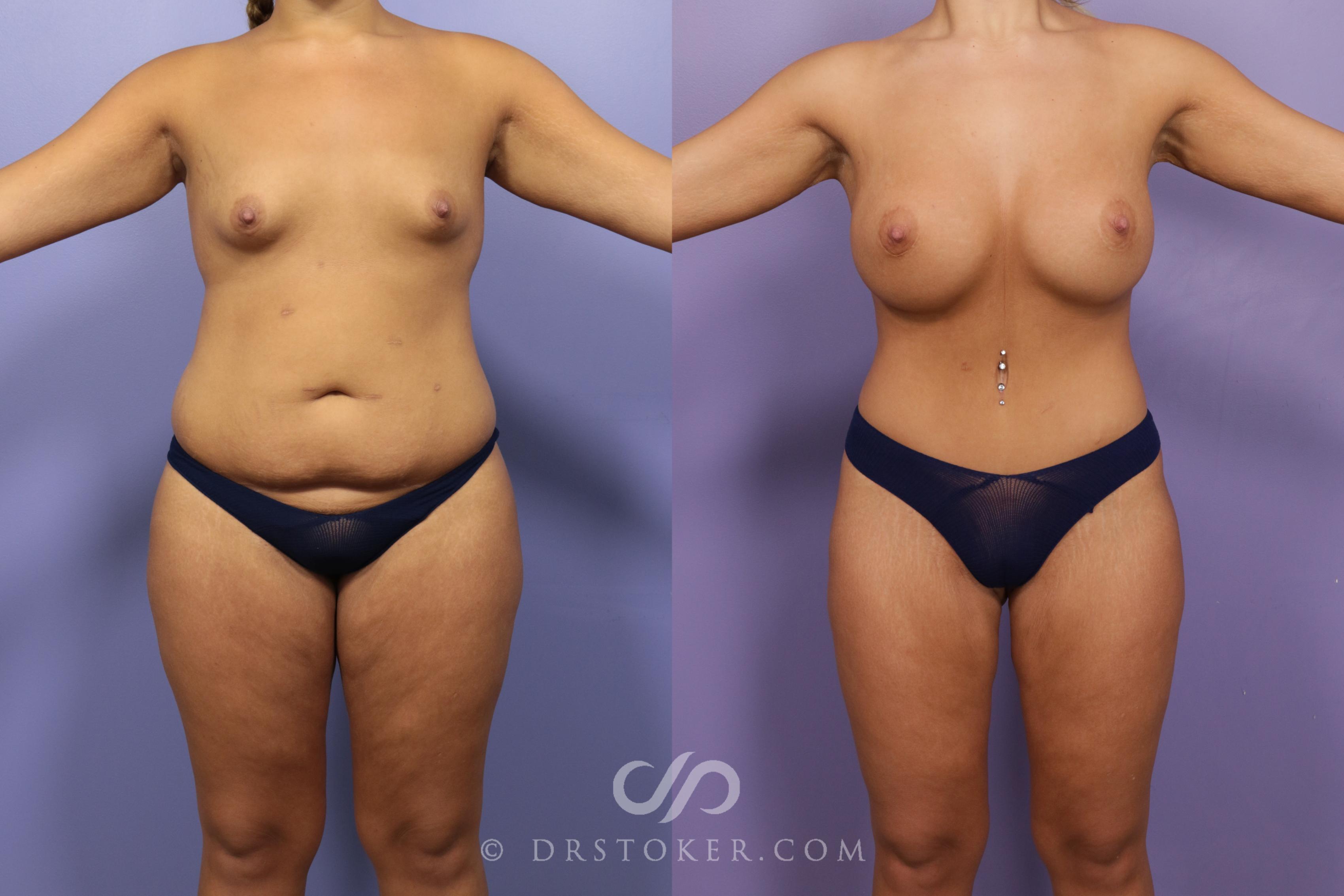 Before & After After Weight Loss Case 1722 View #1 View in Los Angeles, CA