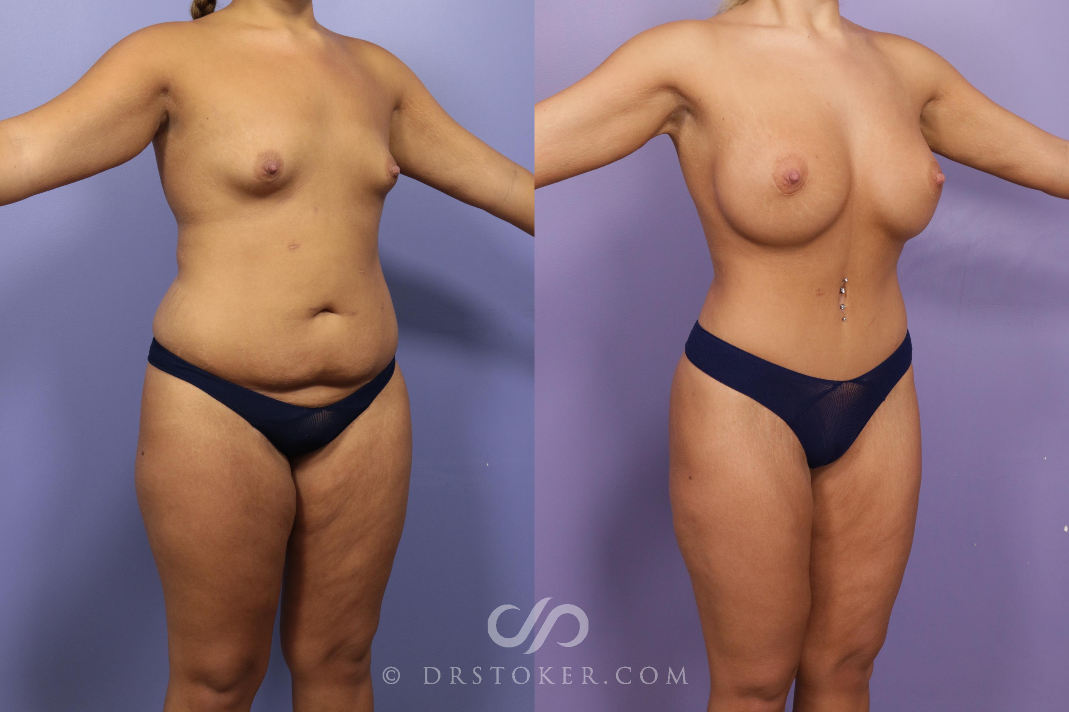 Before & After After Weight Loss Case 1723 View #1 View in Los Angeles, CA