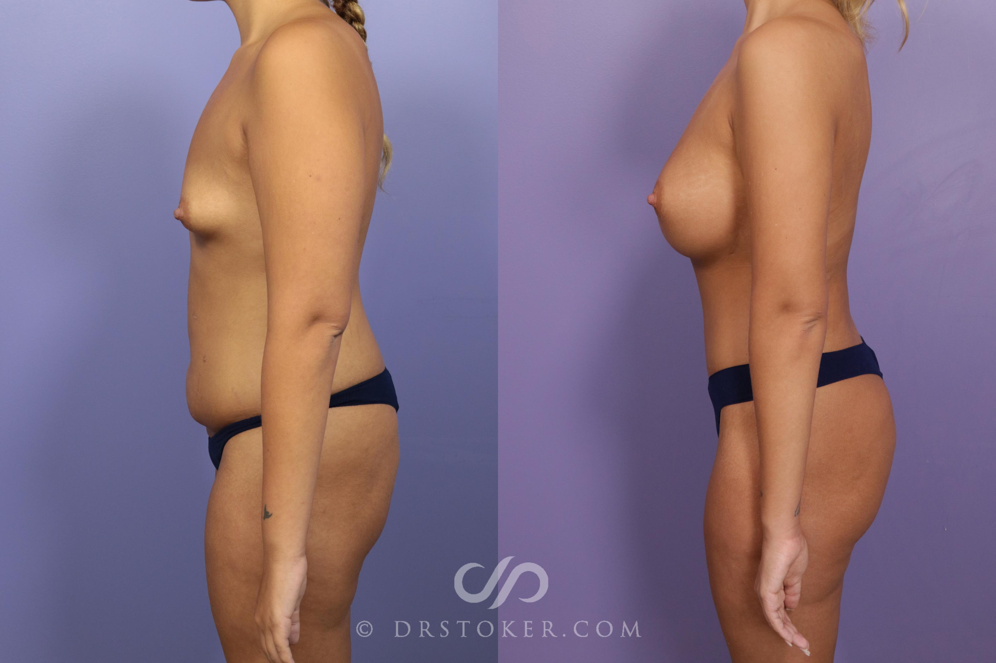 Before & After After Weight Loss Case 1724 View #1 View in Los Angeles, CA